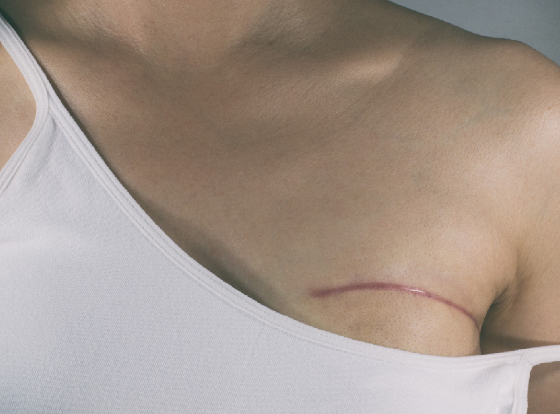 Fully Aware of Your Breast Reconstruction Options