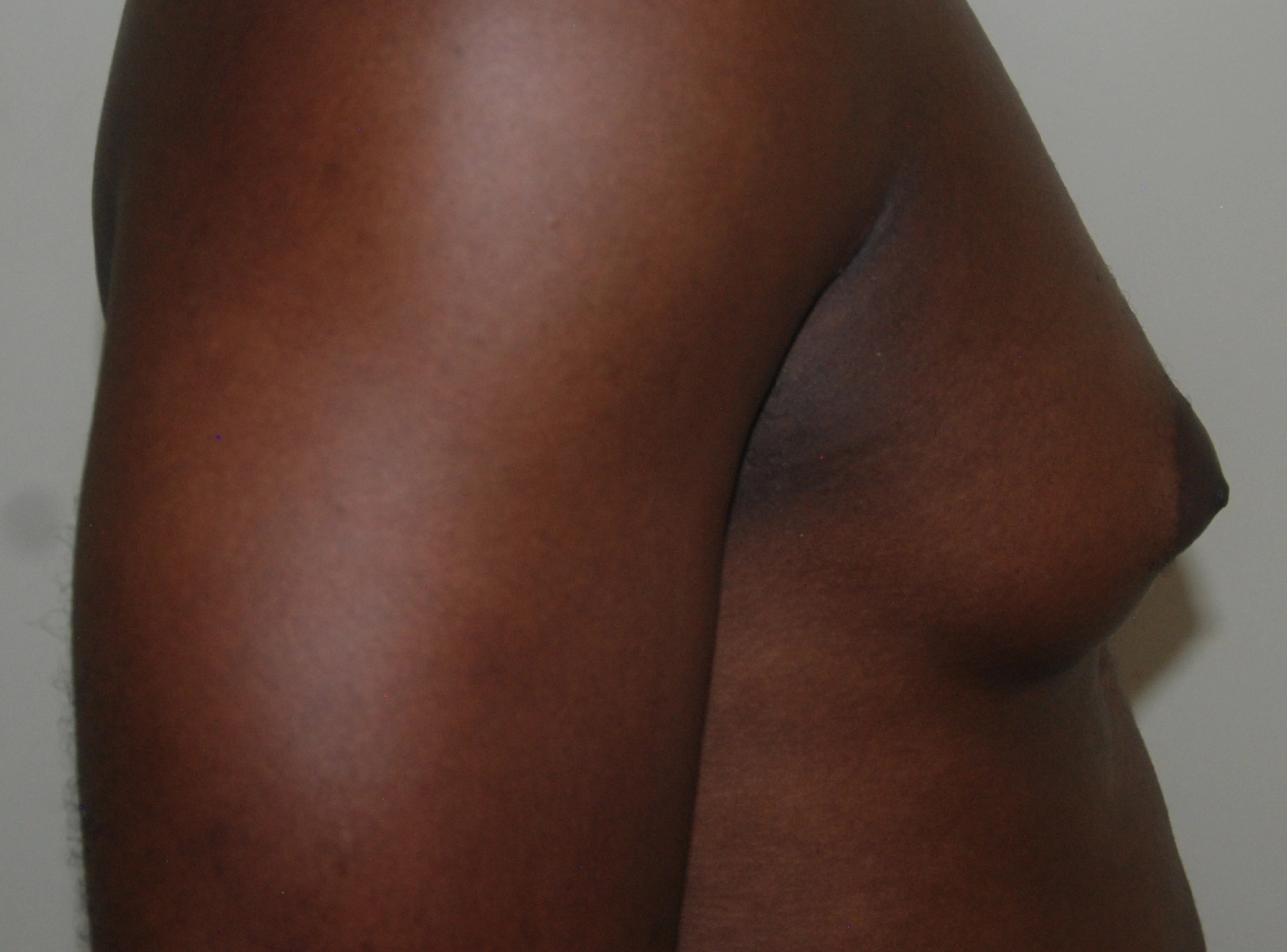 Scar Tissue Development After Gynecomastia Surgery