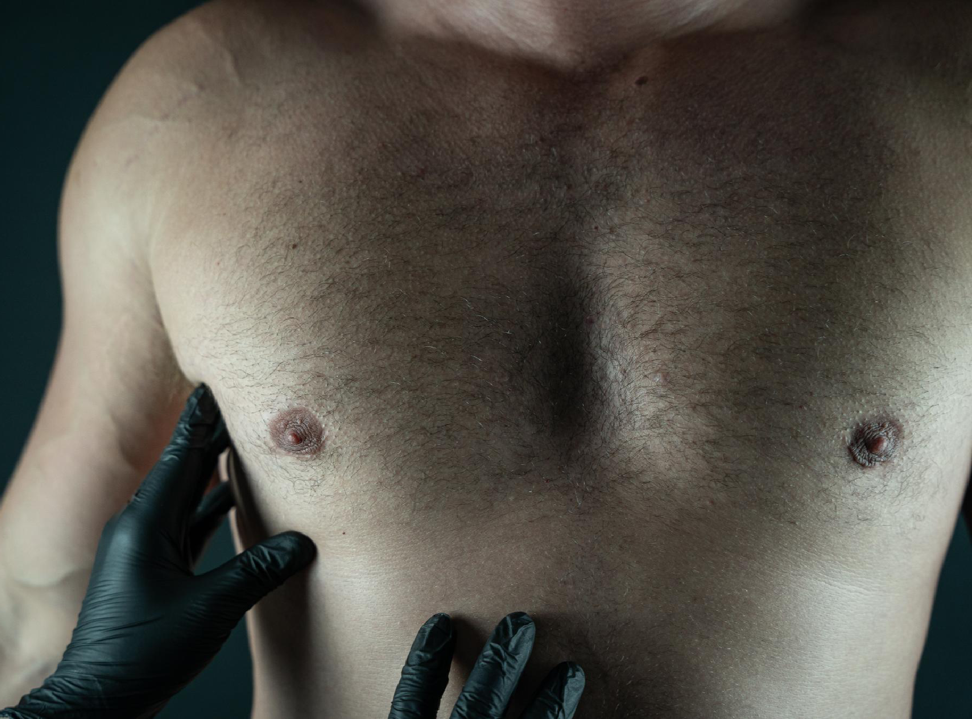 Things to Know Prior to Gynecomastia Surgery in Dubai