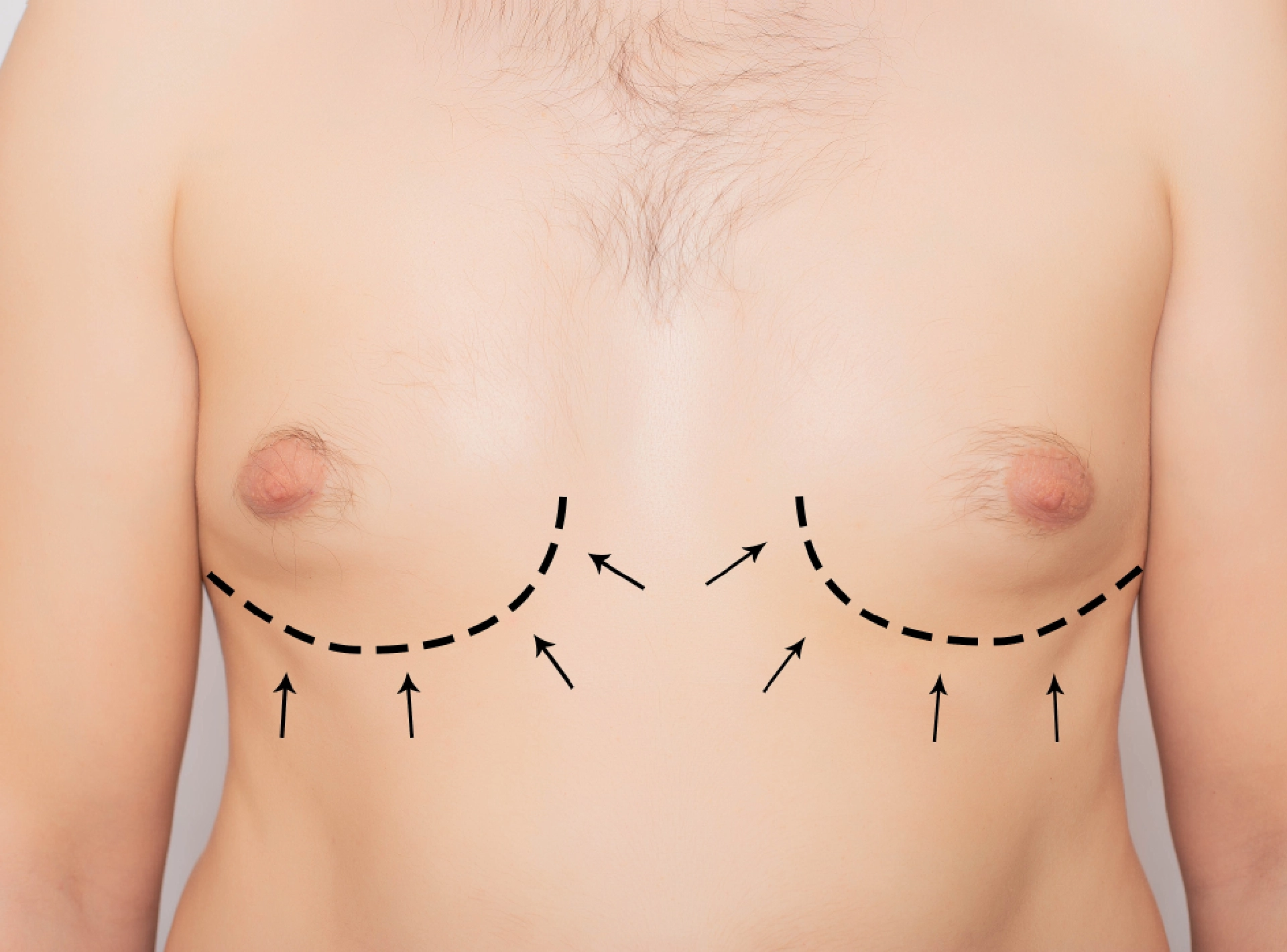 Role of Liposuction in Gynecomastia Surgery