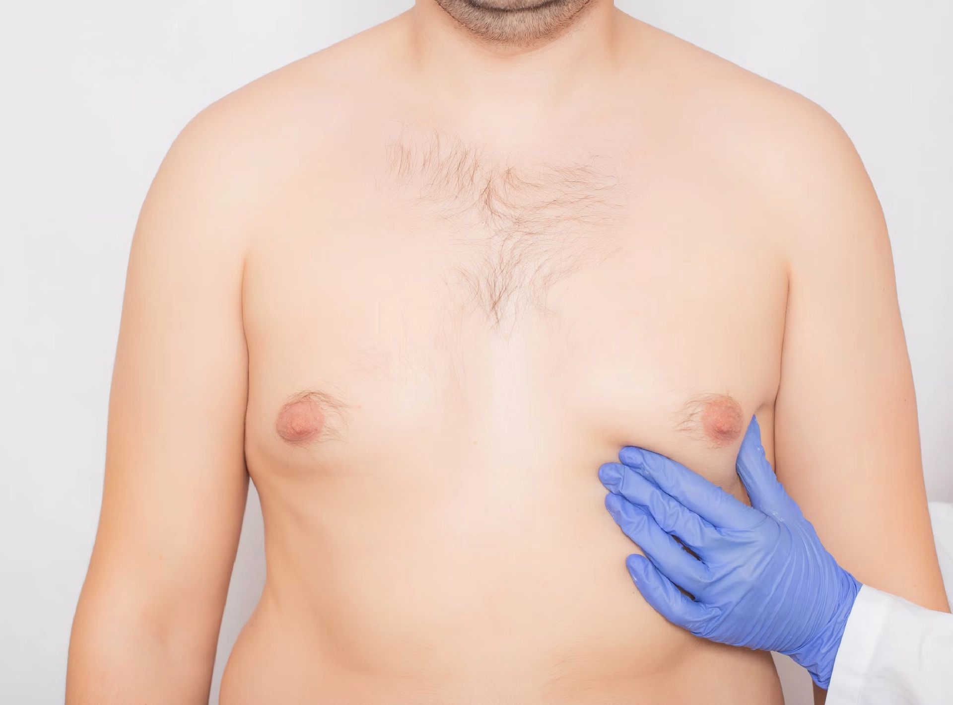 Achieve the Best Gynecomastia Surgery in Dubai with Scarless Procedures