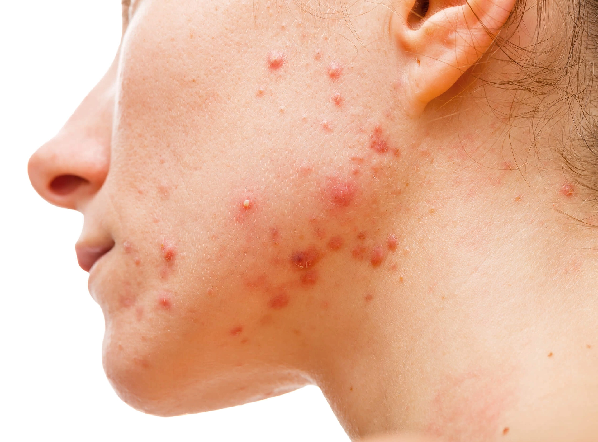 How to Deal with Late-onset Acne