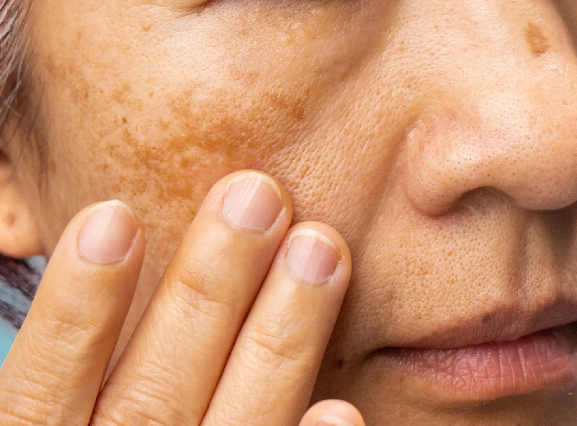 tatiomax glutathione iv review Melasma: Causes, Treatment And Prevention
