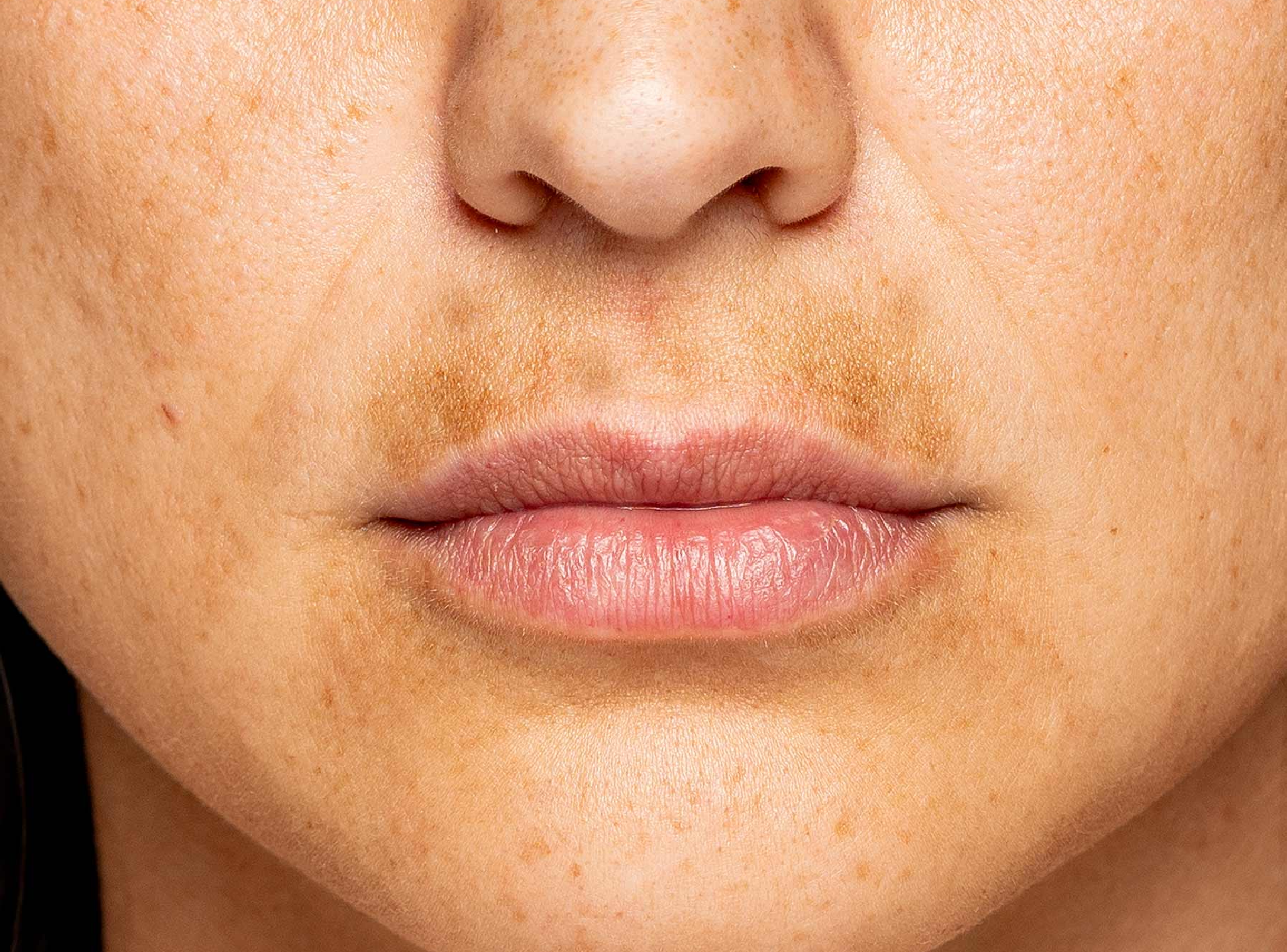 Best Treatment for Melasma