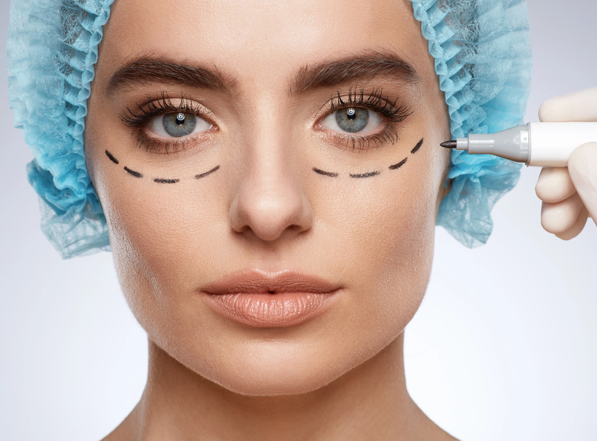 What You Need to Know About Blepharoplasty