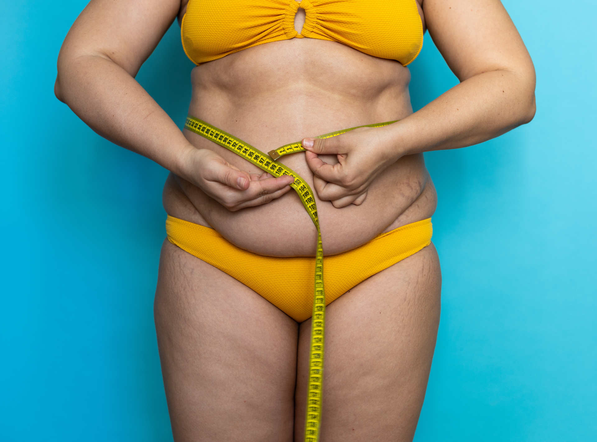 Do Liposuction Scars Go Away?