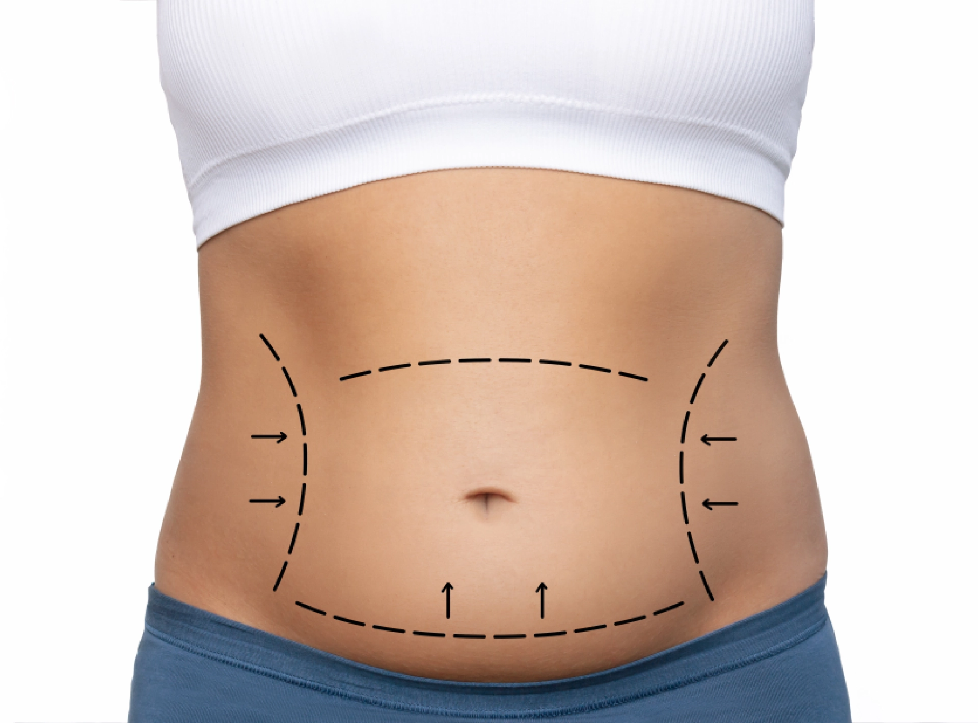 Choosing A Tummy Tuck Procedure | Perfect Doctors Clinic