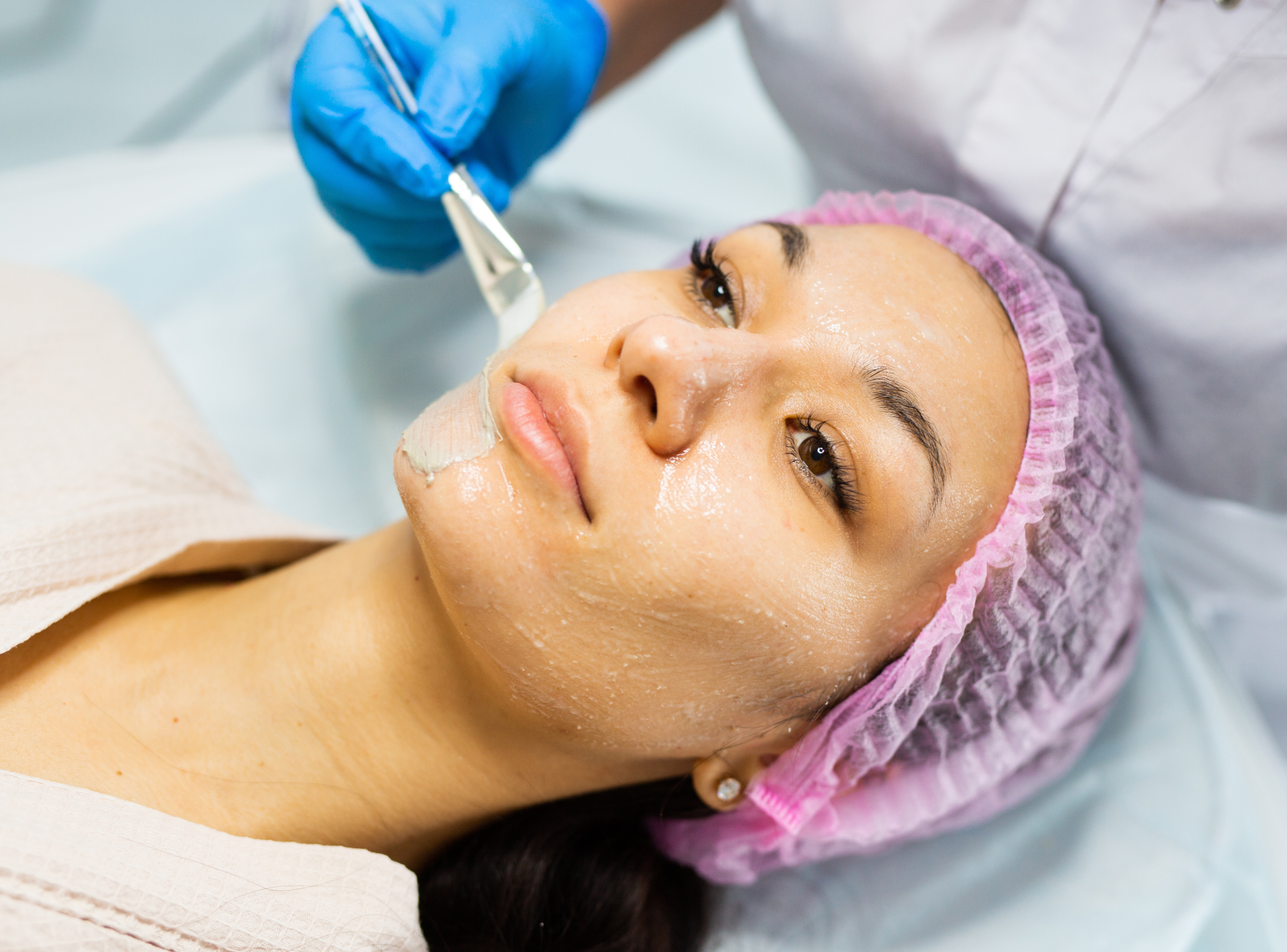 Top 5 Reasons to Embrace Chemical Peels
