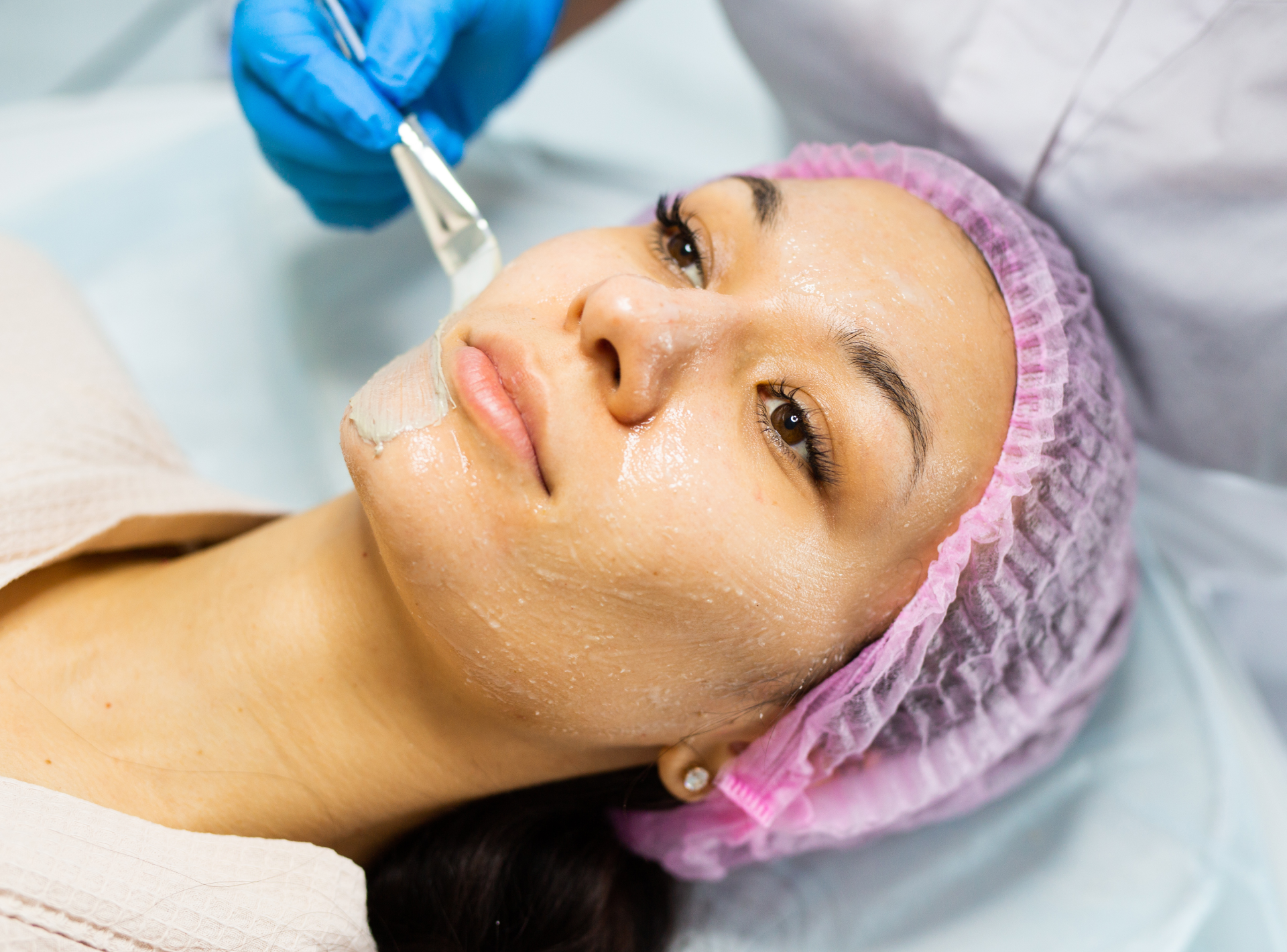 Chemical Peels – the Essential Guide