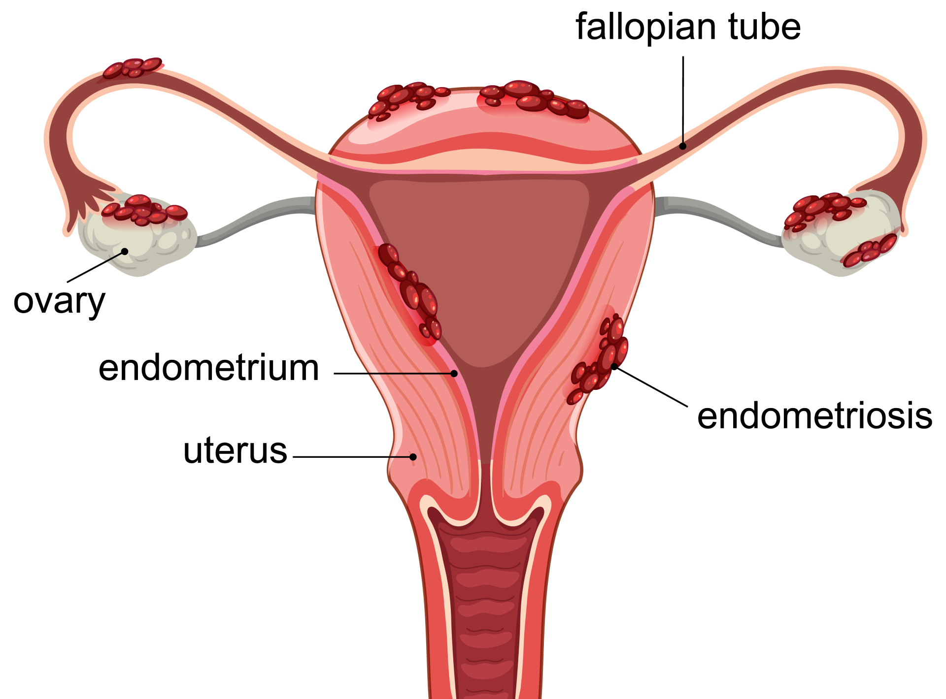 Endometrial Ablation a Safe
