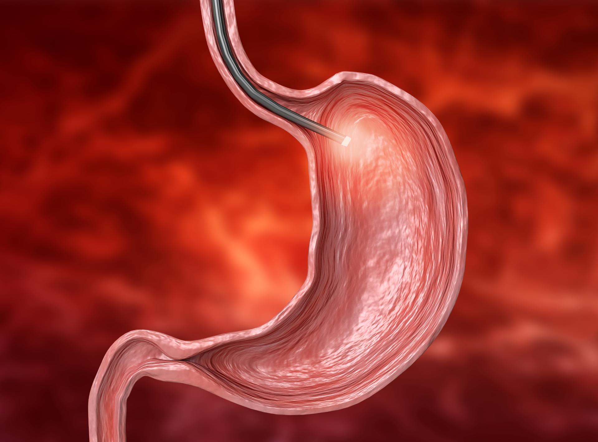 Gastric Plication Recovery and Risk Evaluation