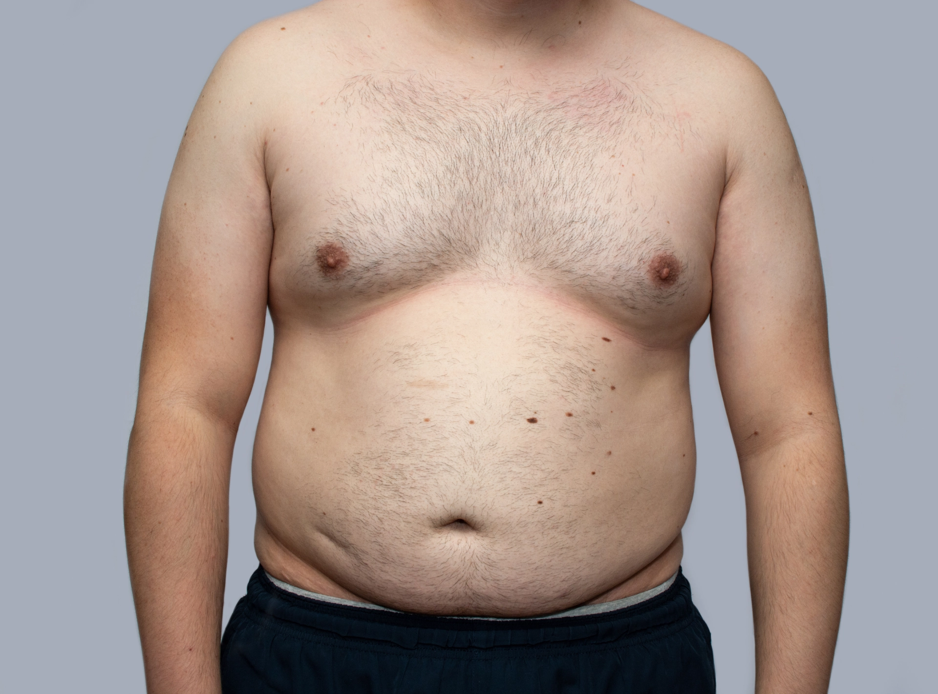 Things No One Tells You Before Gynecomastia Surgery