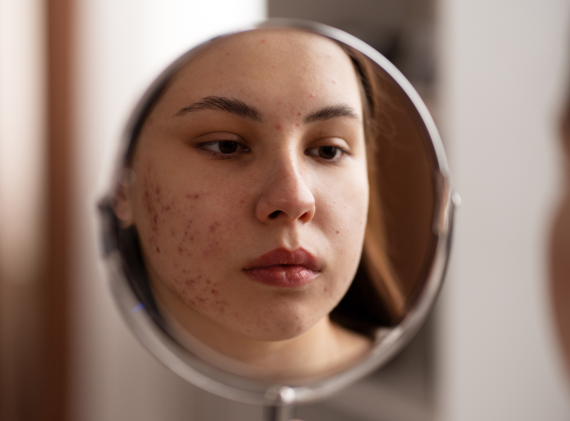 Recovery for Acne Scar Treatments