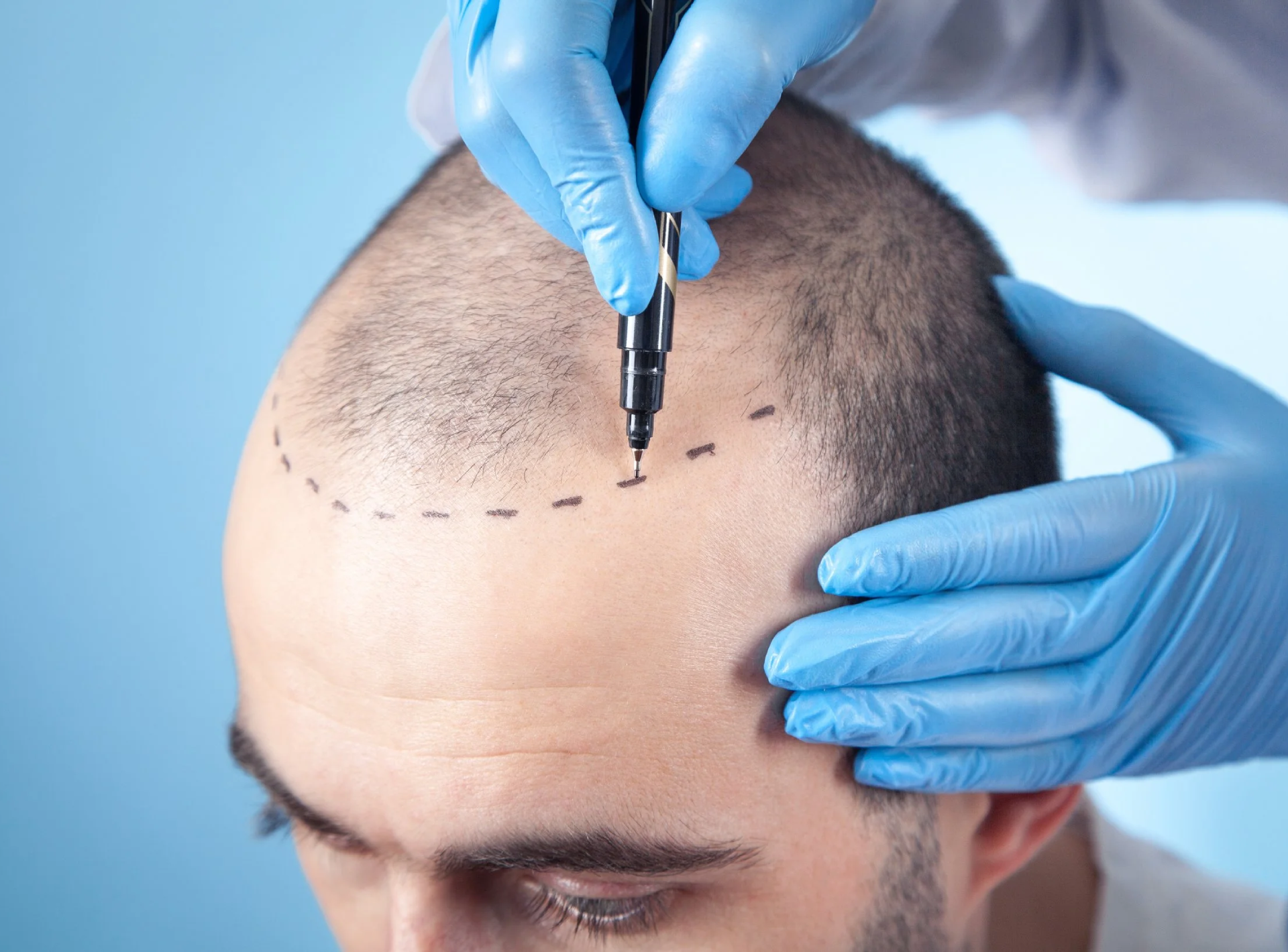Male Hair Transplant Recovery: What to Expect