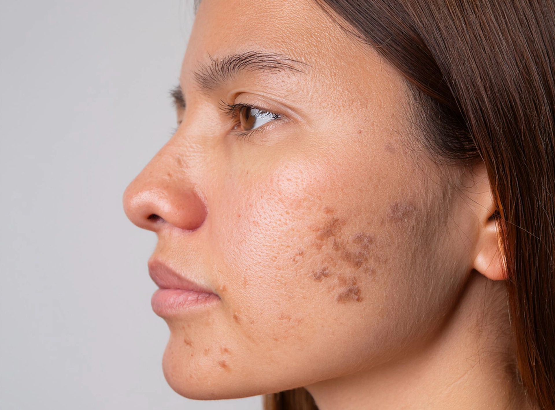 can glutathione cure melasma All About | The Skin Saint Blogs Birmingham Melasma Home Remedies: Aloe Vera,