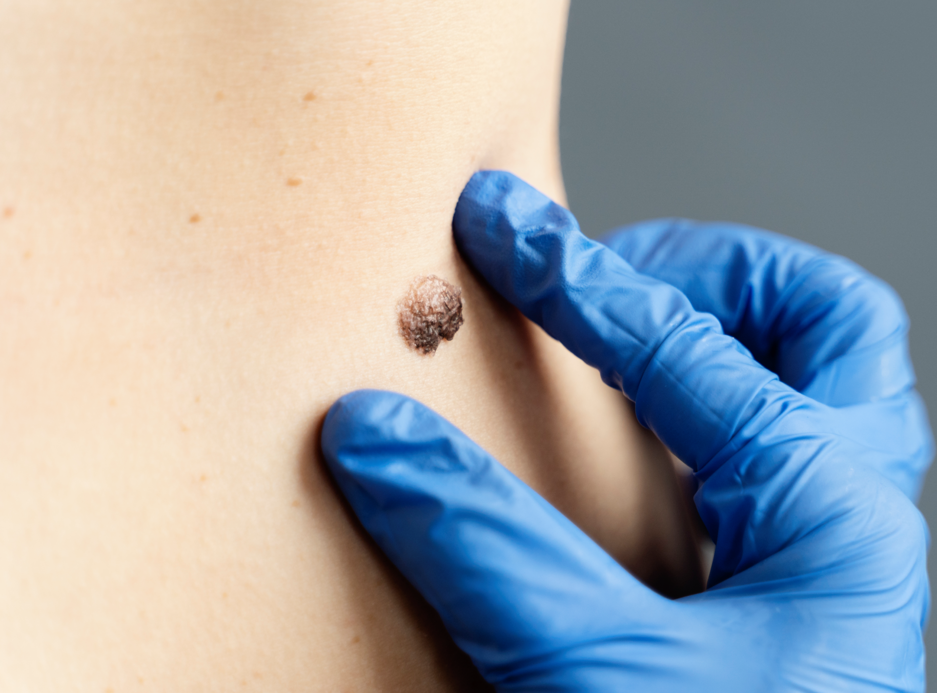 Is Mole Removal Safe And Effective?