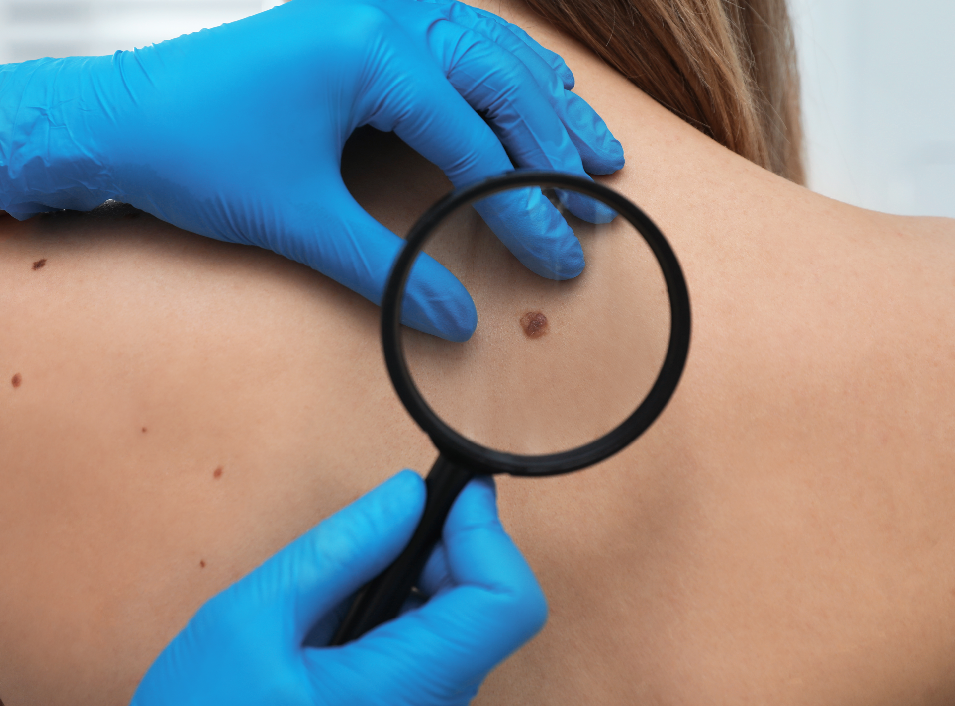 Harmful to Have Moles Removed