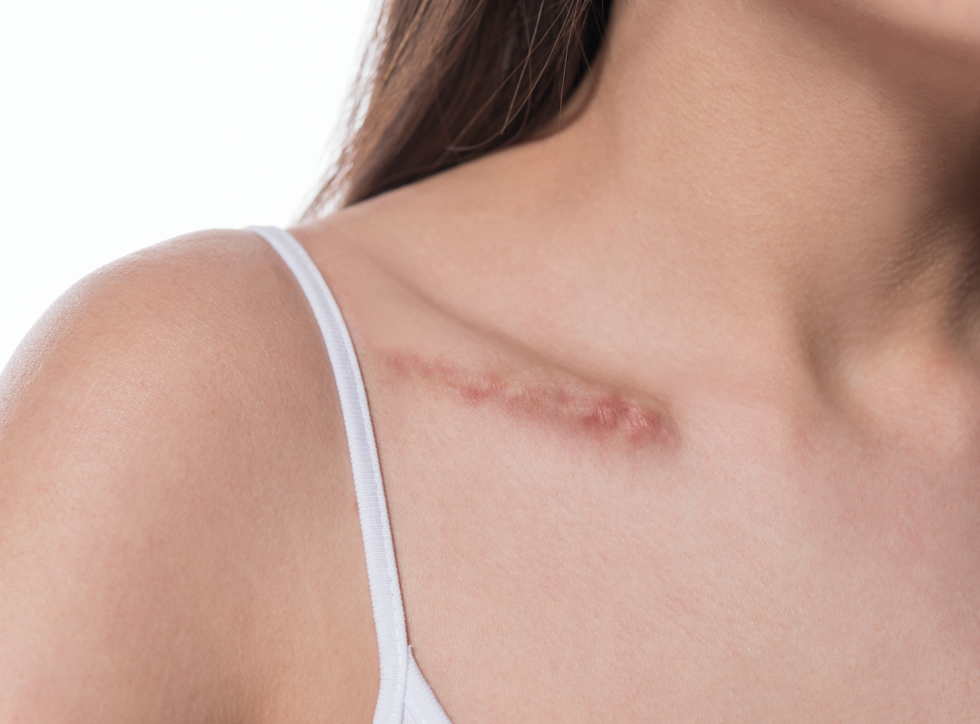 How Scar Removal Surgery Can Help You – a Complete Guide