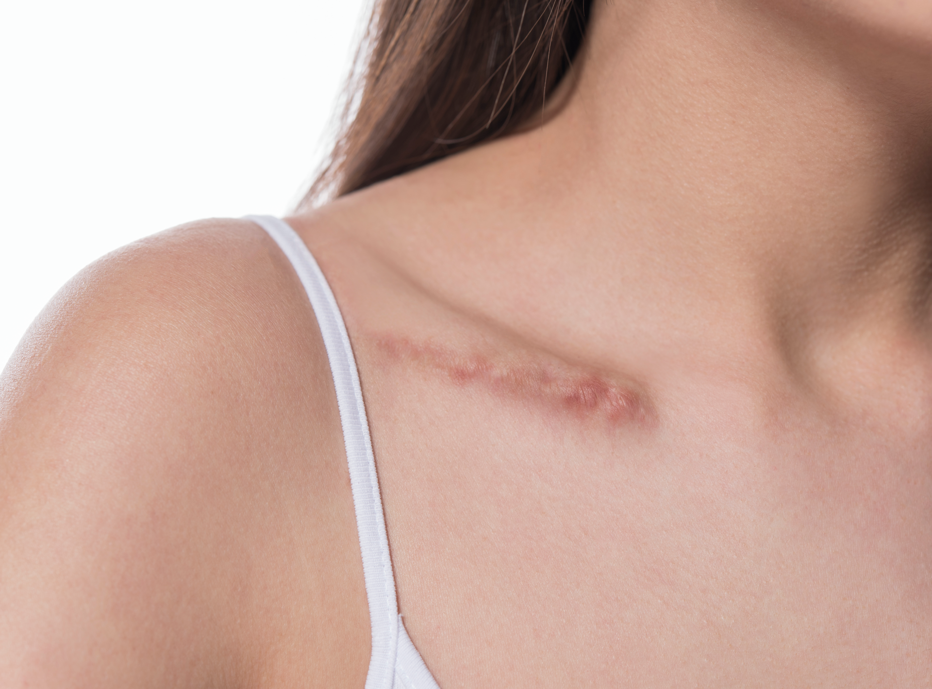 Scar Treatments That Restore Your Complexion
