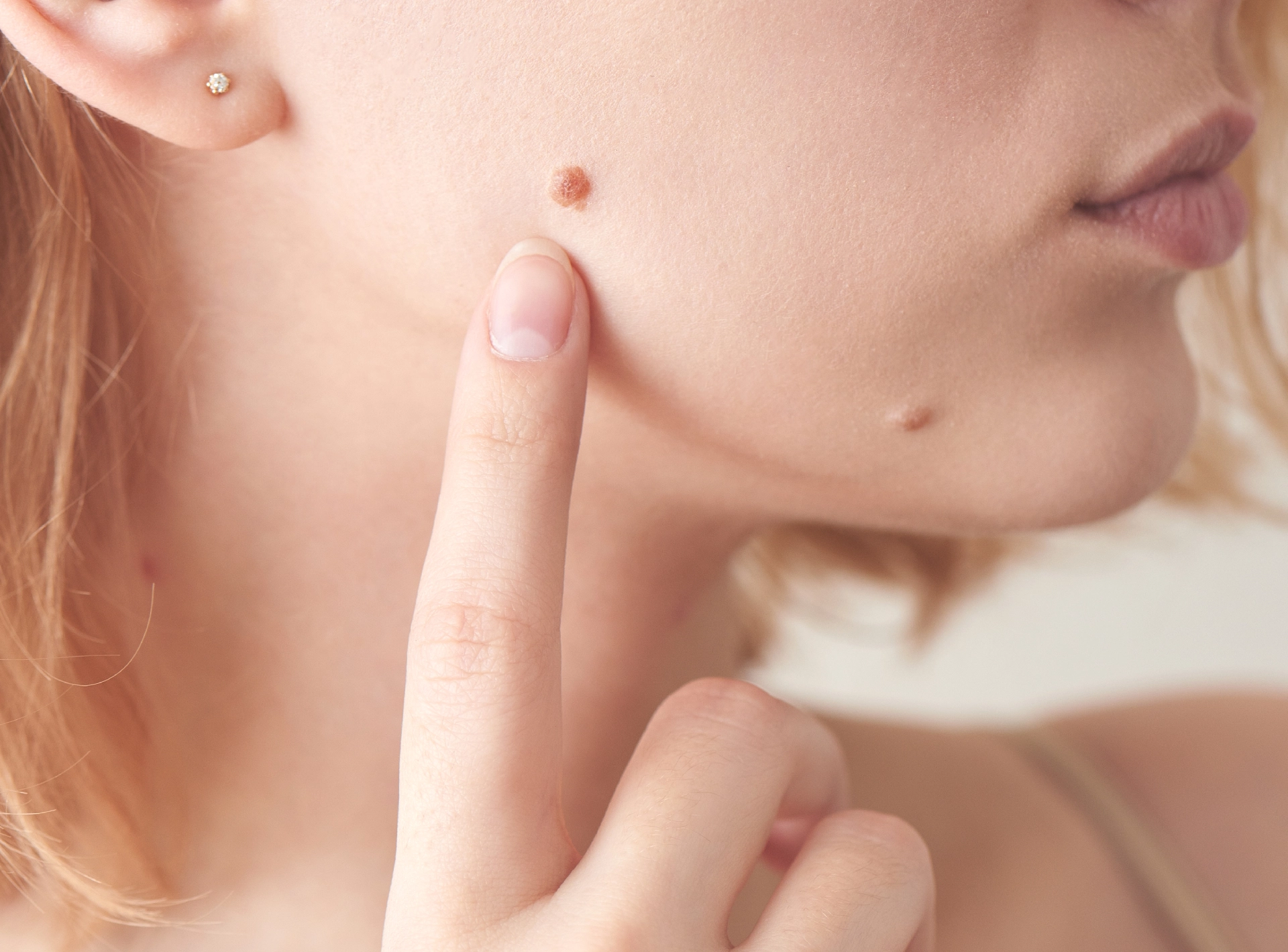 How To Get Rid Of Skin Tags Removal
