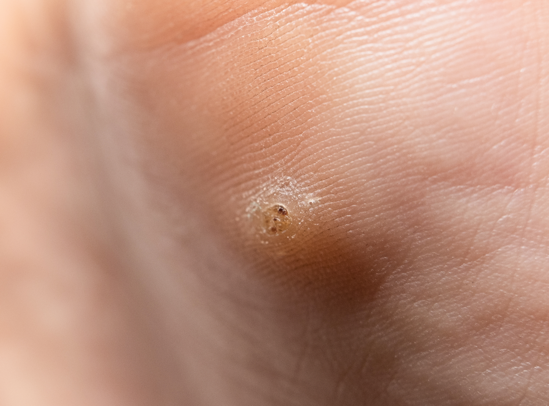 Choose the Right Treatment for Warts
