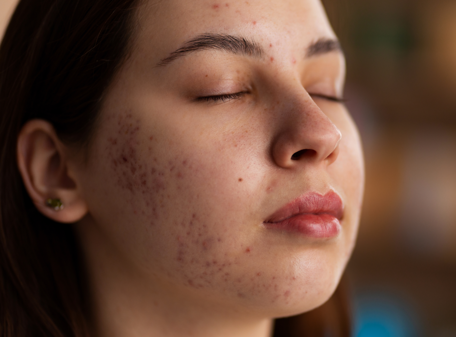 Laser Free Acne Scar Treatments You Should Try