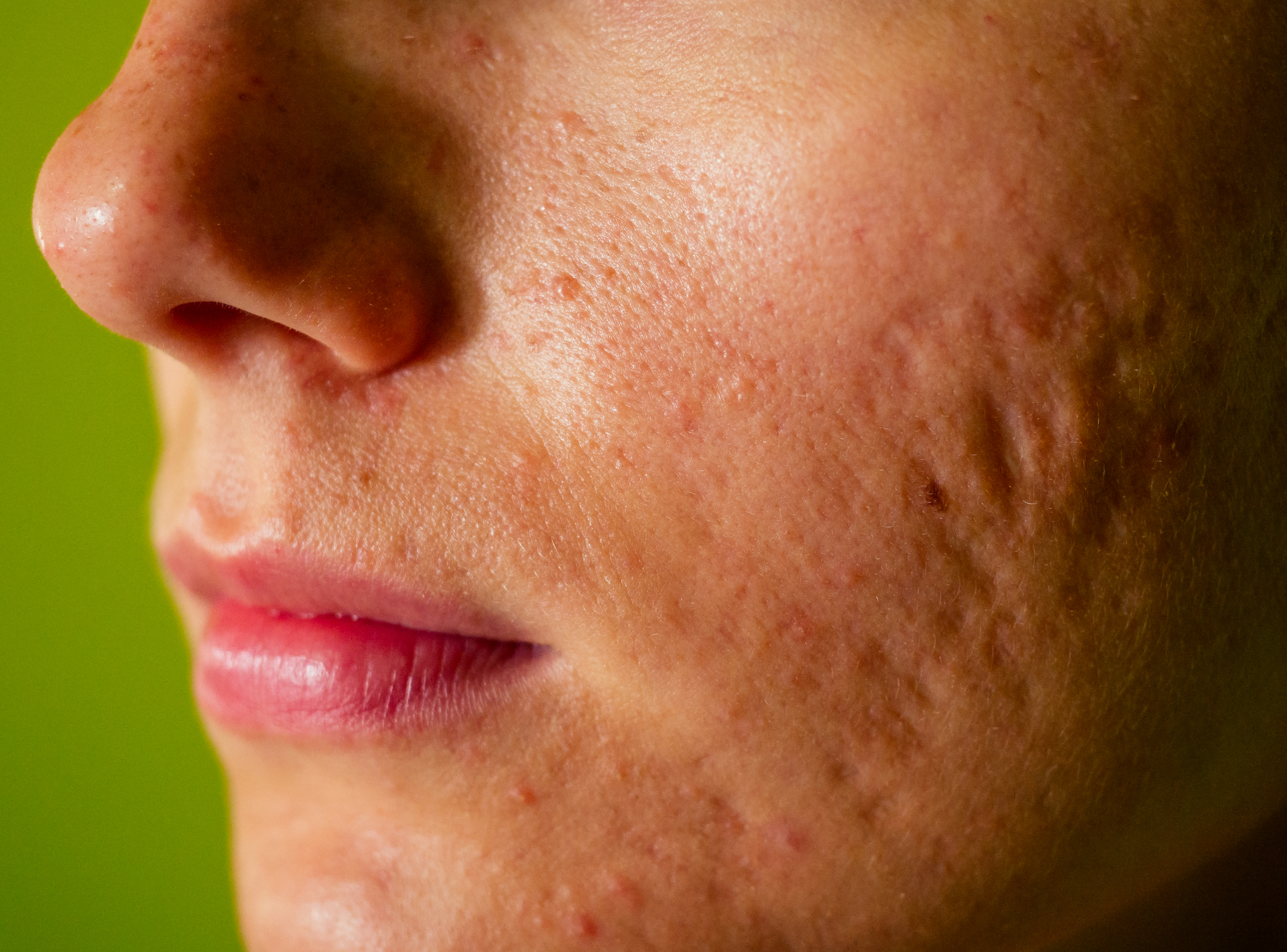 Acne Scarring: How to Prevent and Treat It