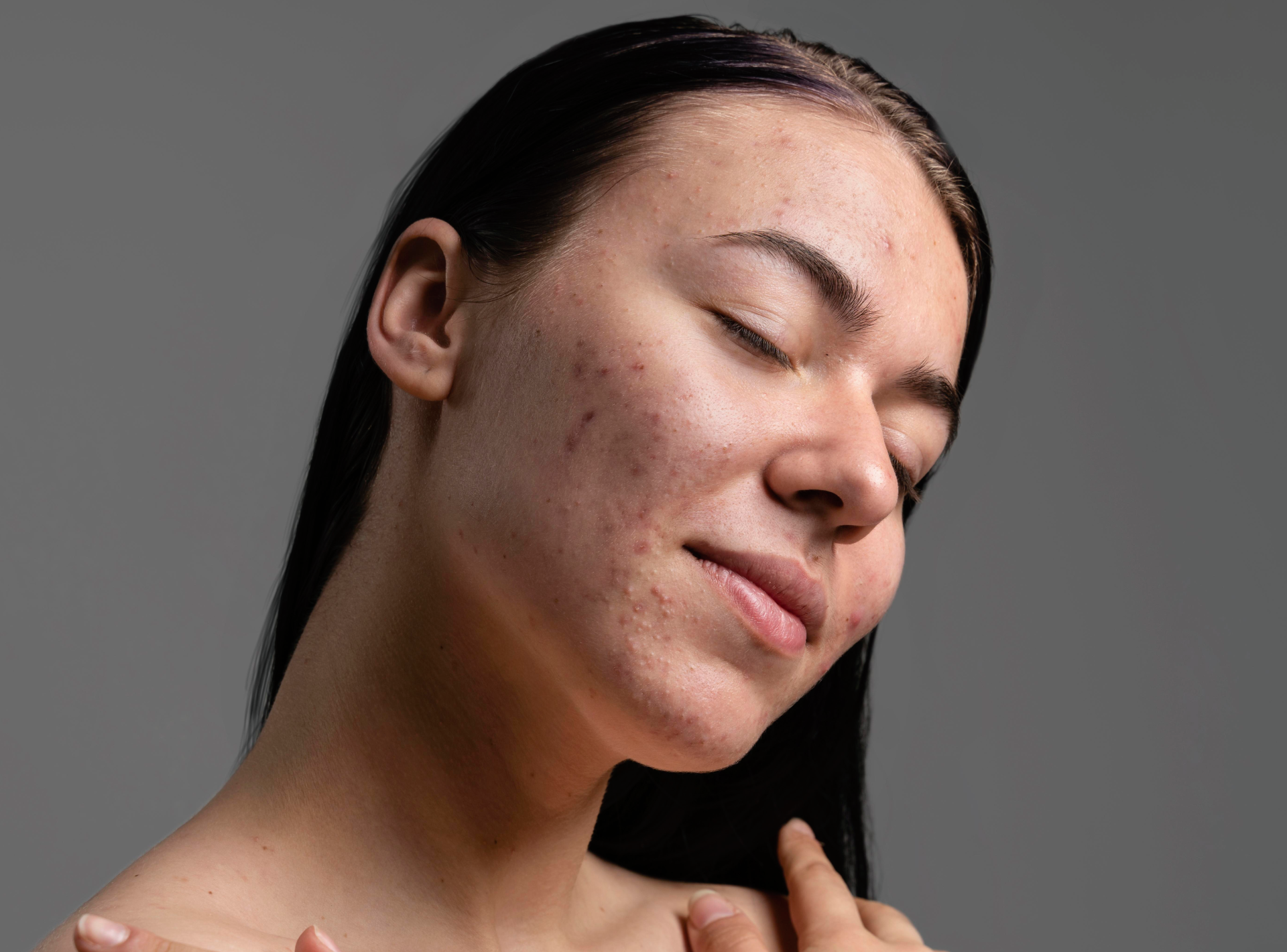 Say Goodbye to Acne Scars