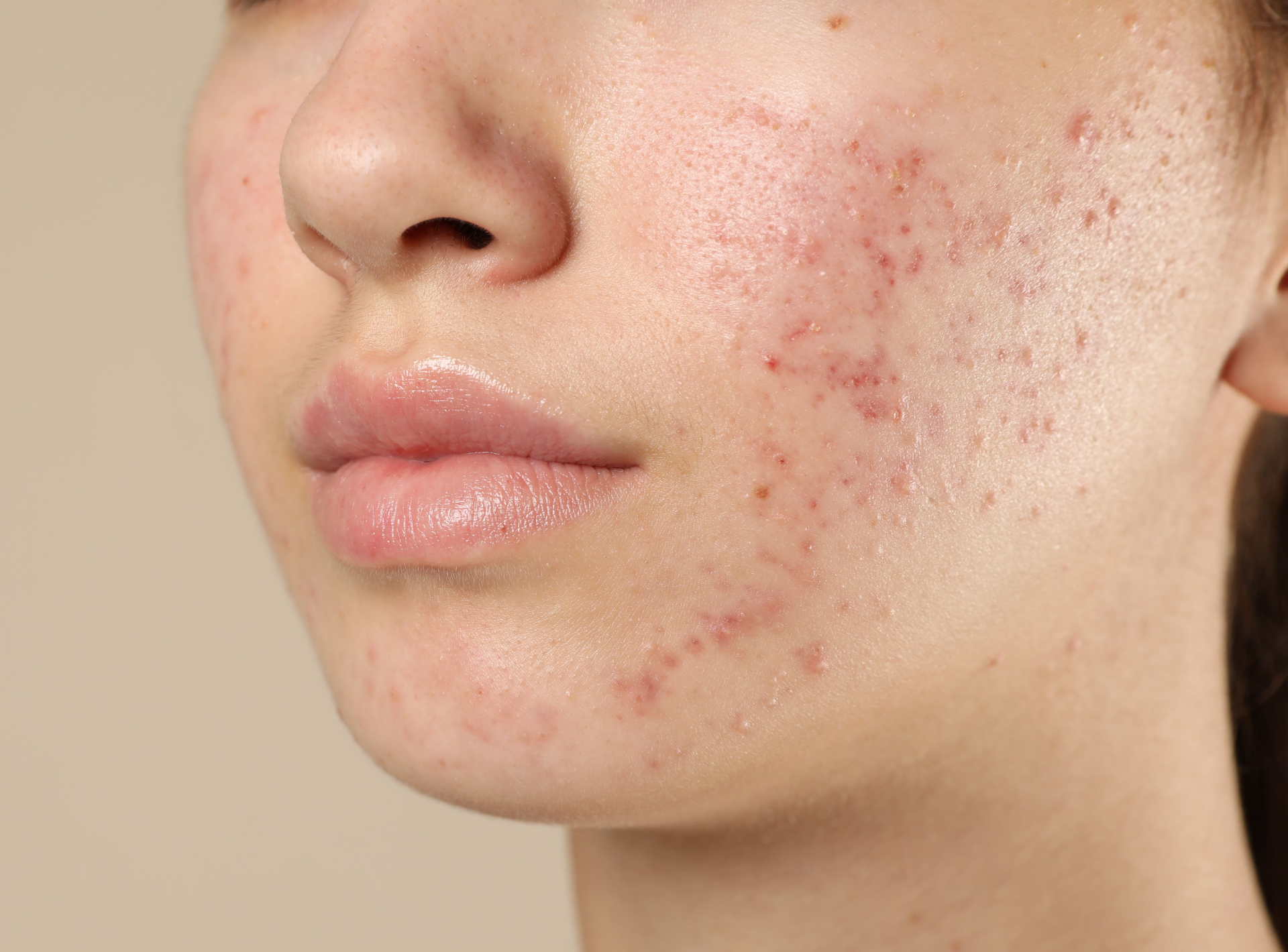 the Hidden Risks of Acne Treatment
