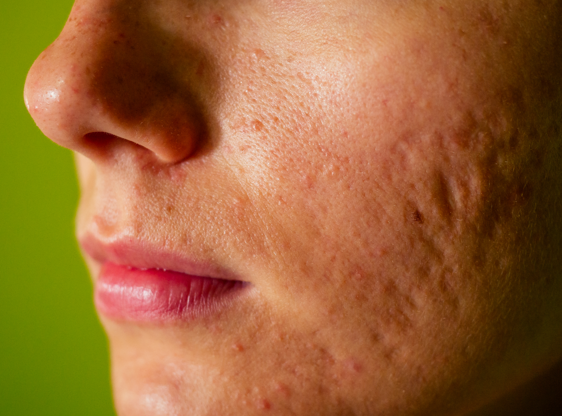 Side Effects of Acne Treatment