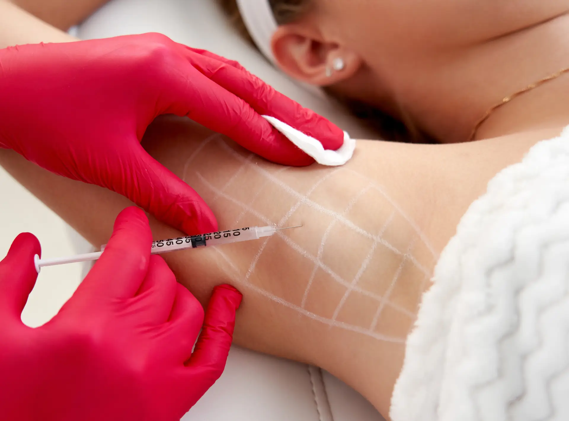 Botox for Sweating: Questions Answered