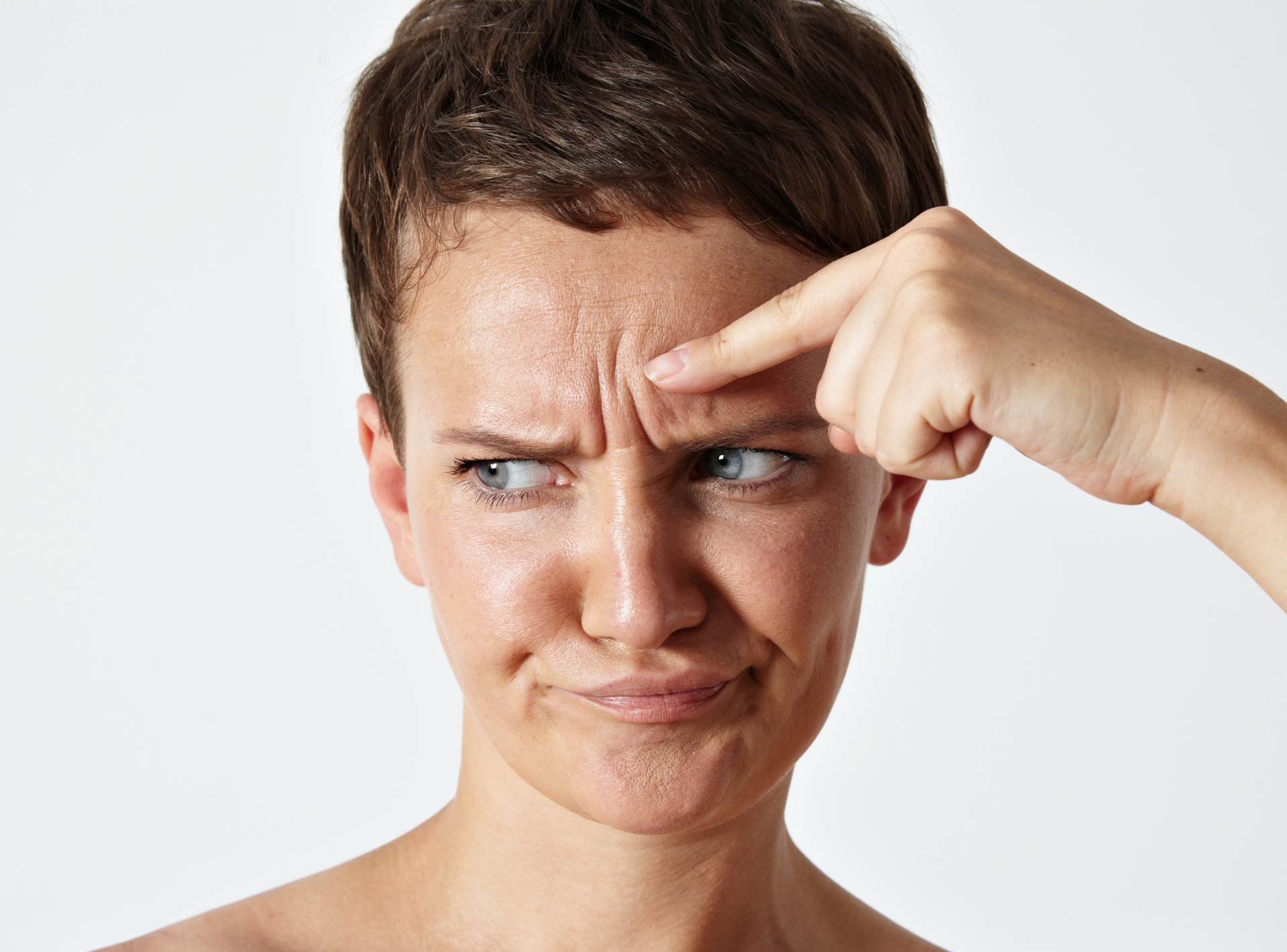 Botox Recovery for Crow’s Feet