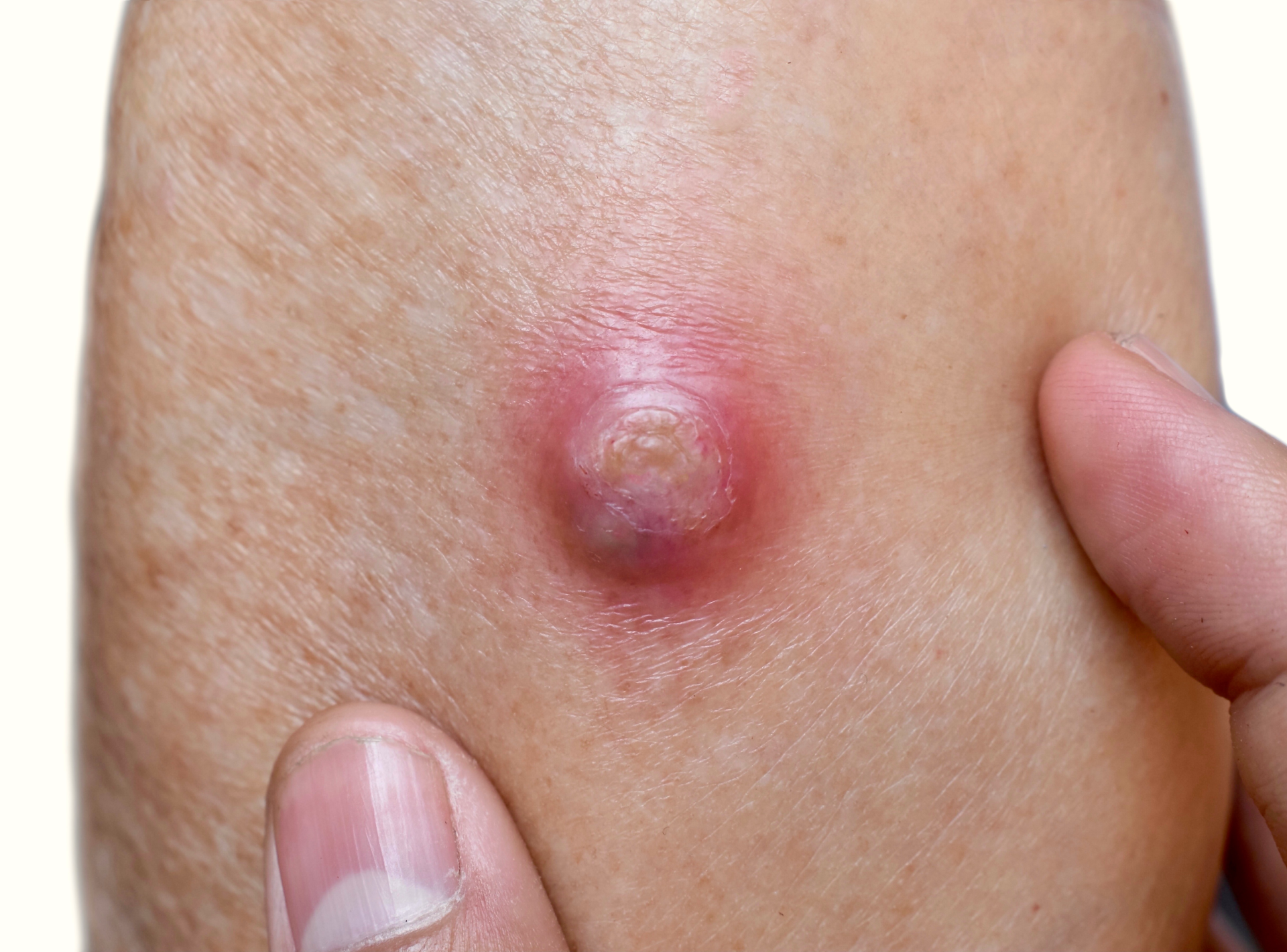 Complications of Cyst Surgery