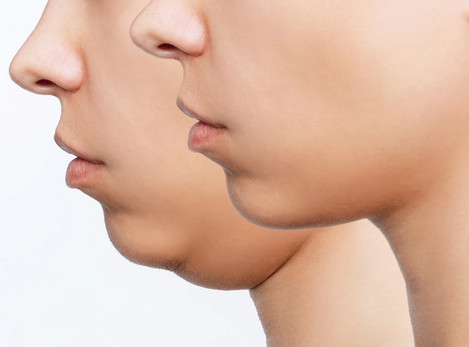 Are Any Risks Involved with Liposuction of a Double Chin?