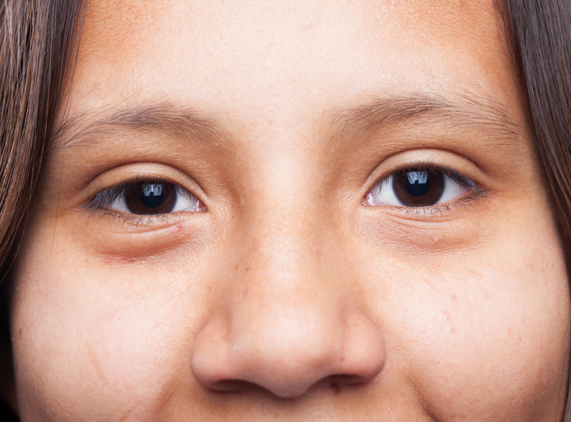 Eye Bag Surgery (lower Blepharoplasty)