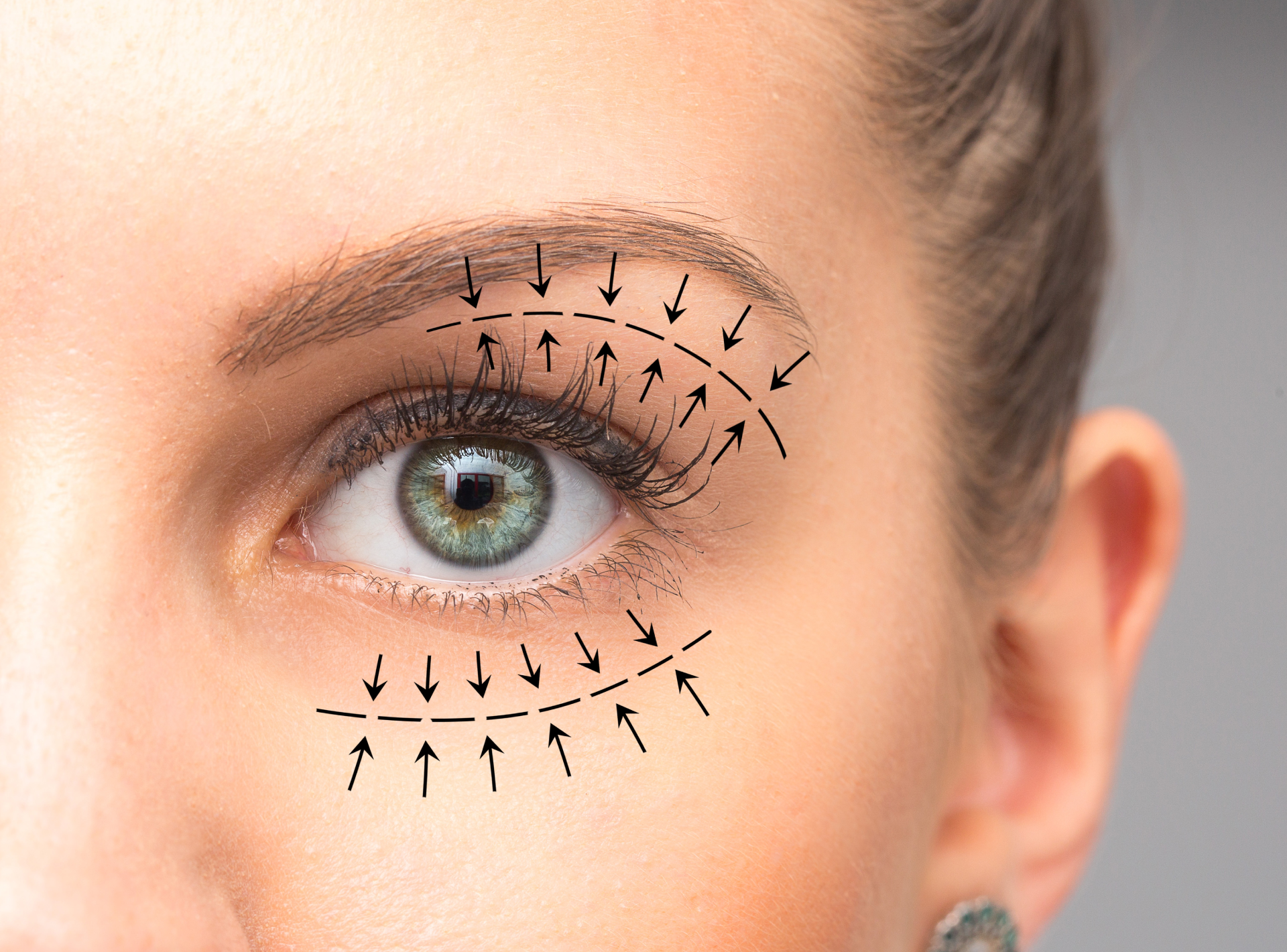 Eyelid Surgery – Questions to Ask Your Surgeon