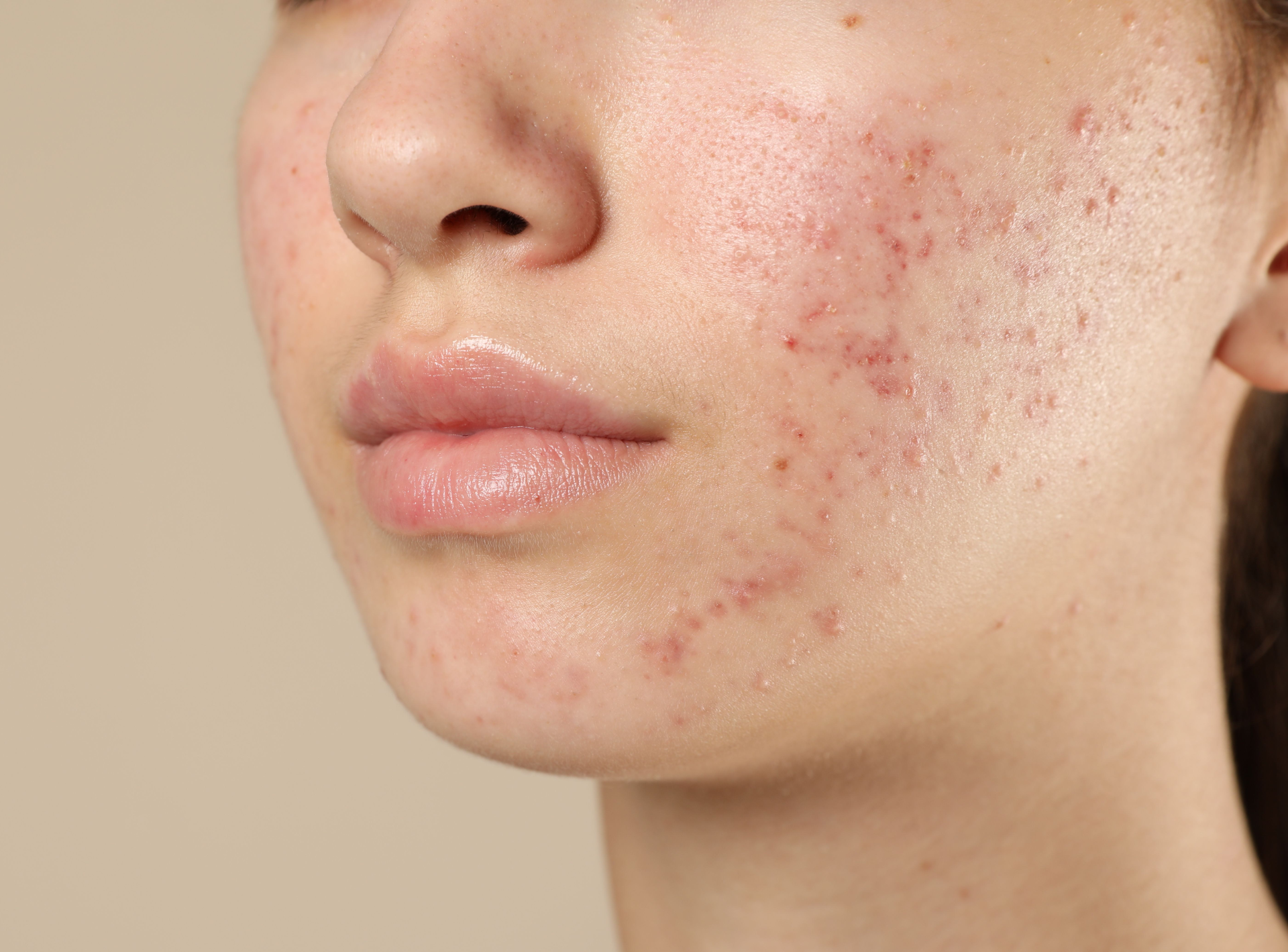 Laser Acne Scar Risks and Complications