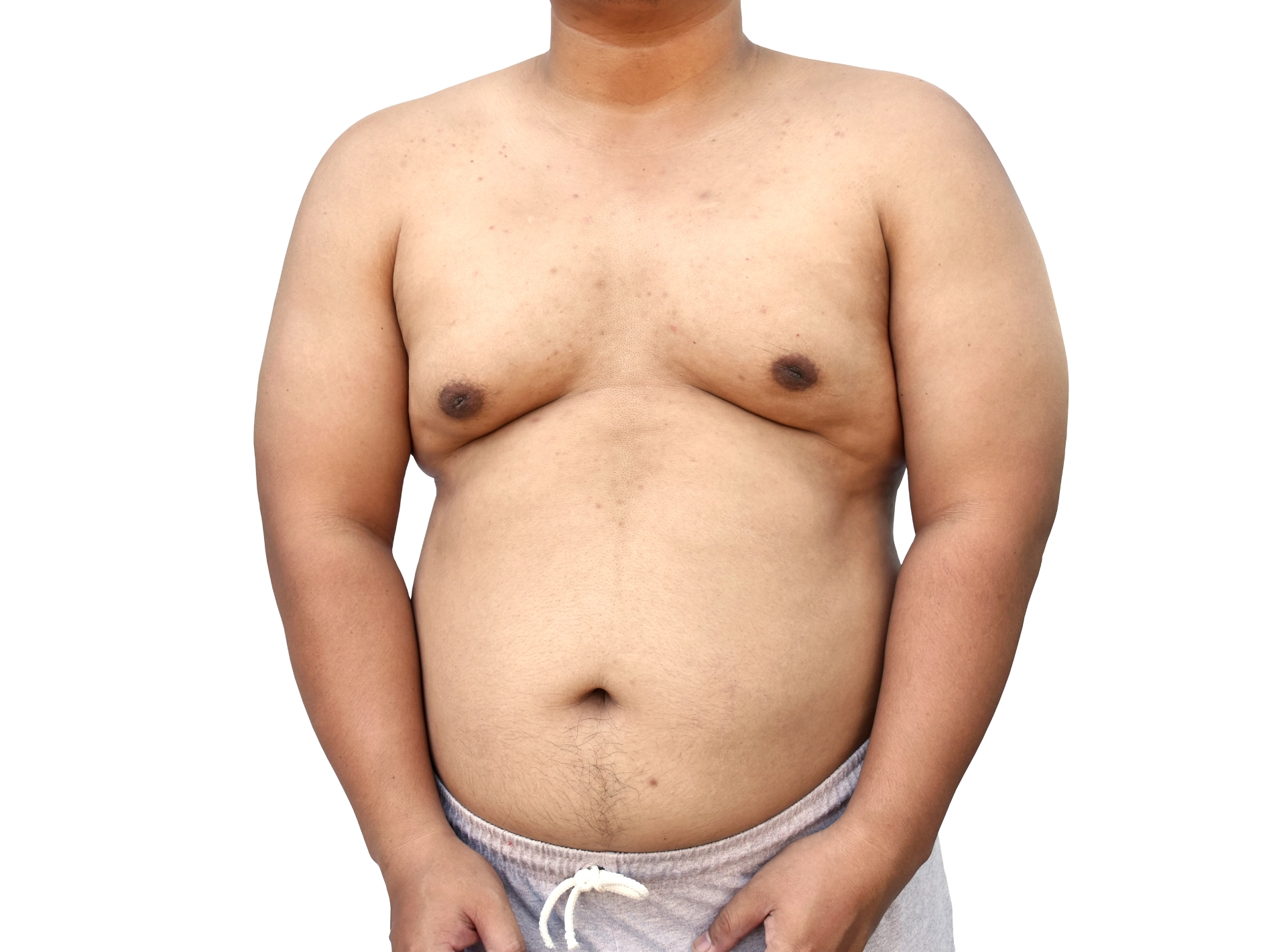 What Are the Risks of Male Breast Reduction Surgery?