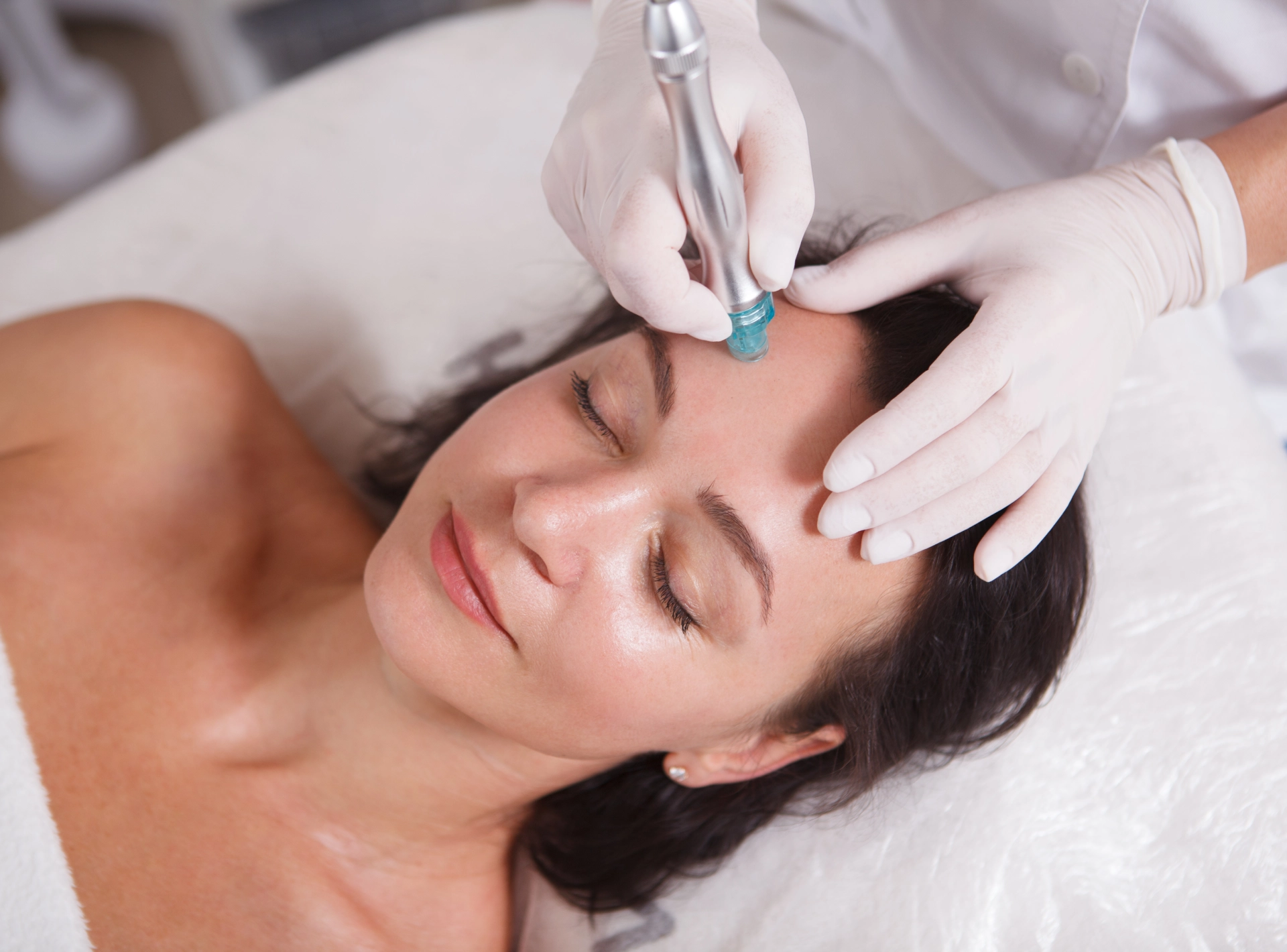 Microneedling Side Effects
