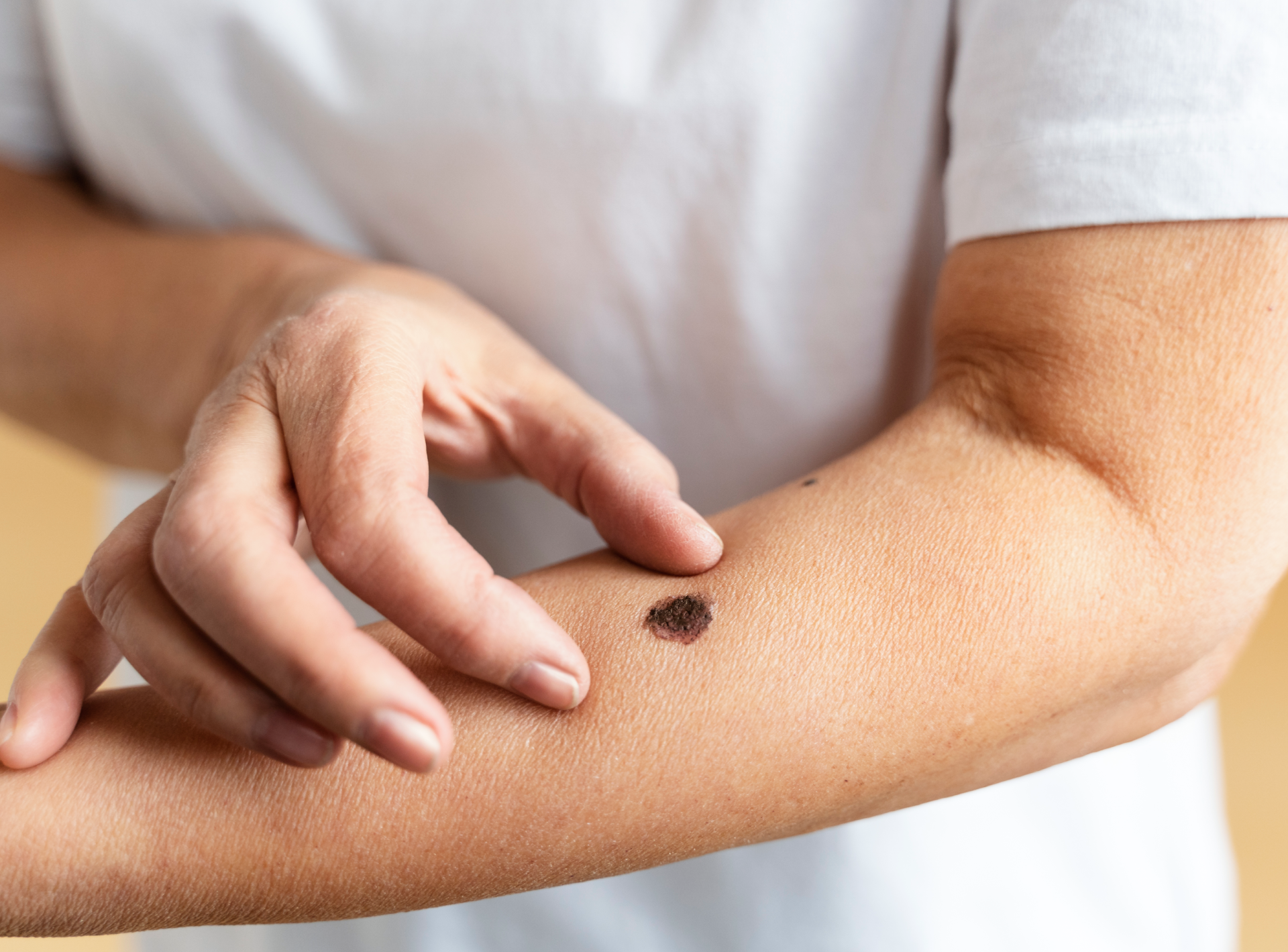 is It Safe to Have Moles Removed?