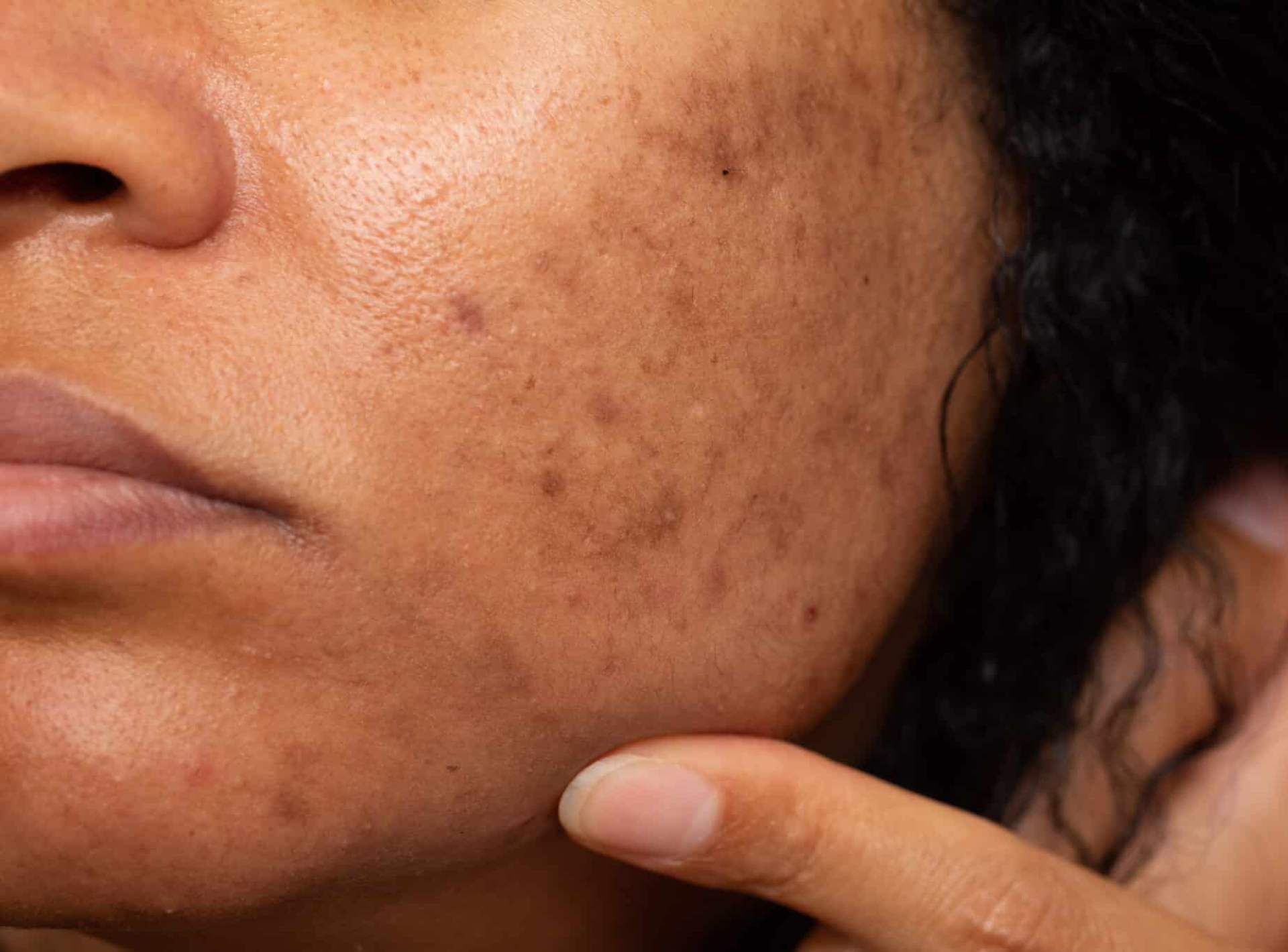Acne Scar Treatment for Brown Skin