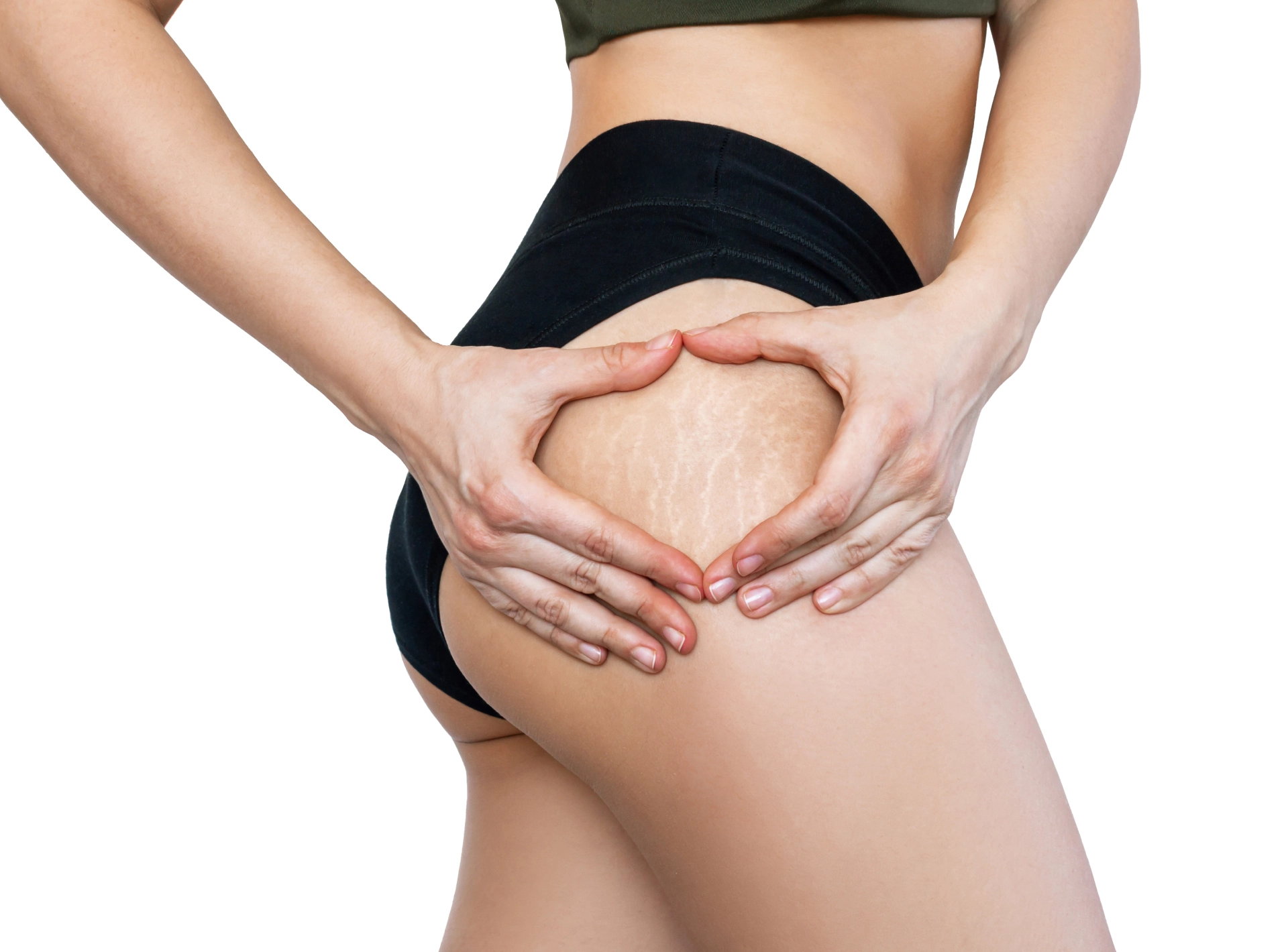 Are There Any Side Effects After Stretch Mark Removal?