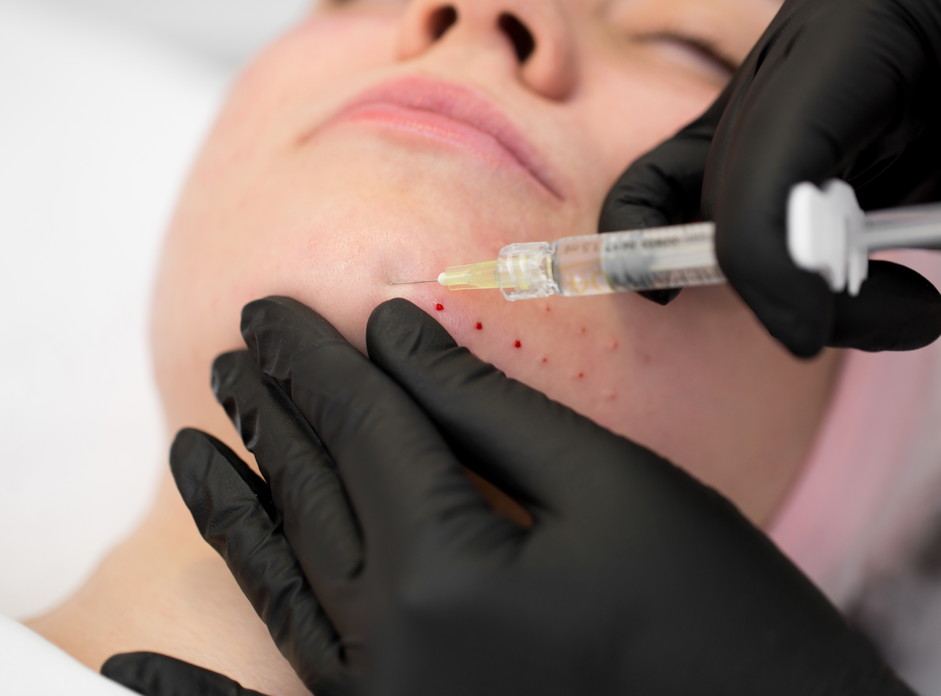 is a Vampire Facial Safe?