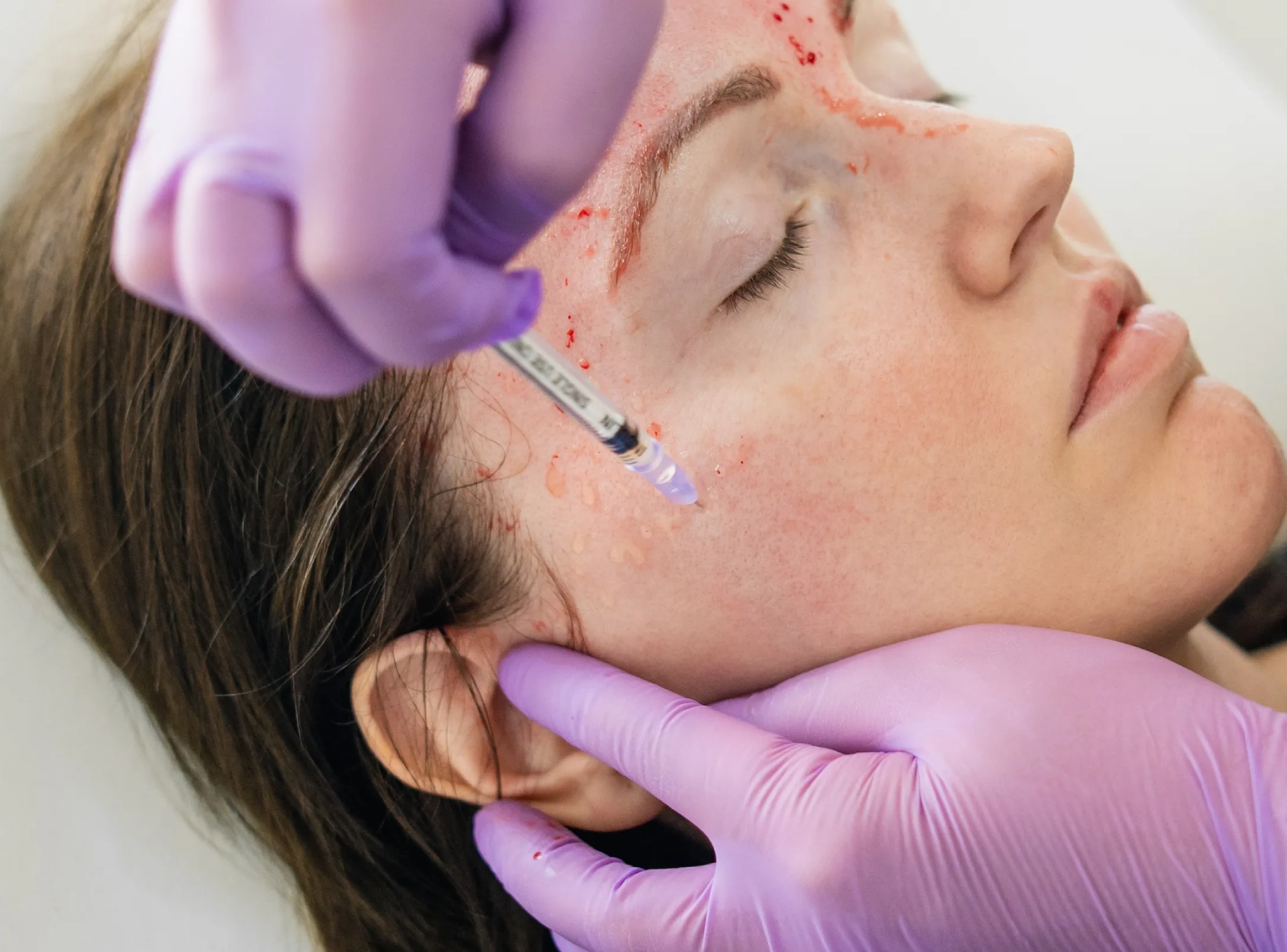 the Truth About Vampire Facials
