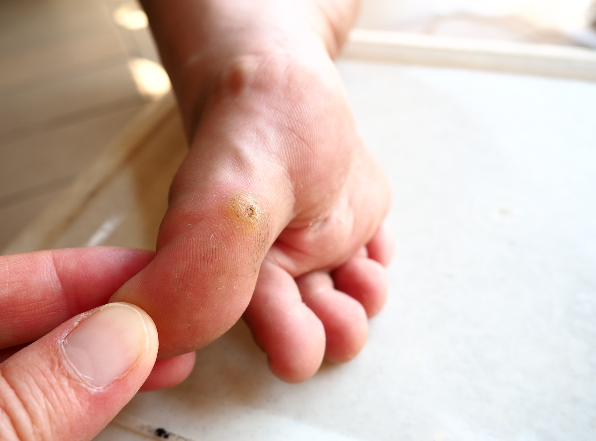 Risks Of Removing Warts At Home