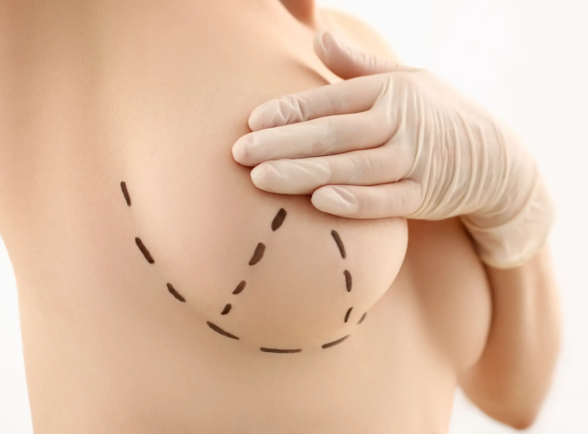 Post-pregnancy Breast Lift: Restoring Your Body After Childbirth