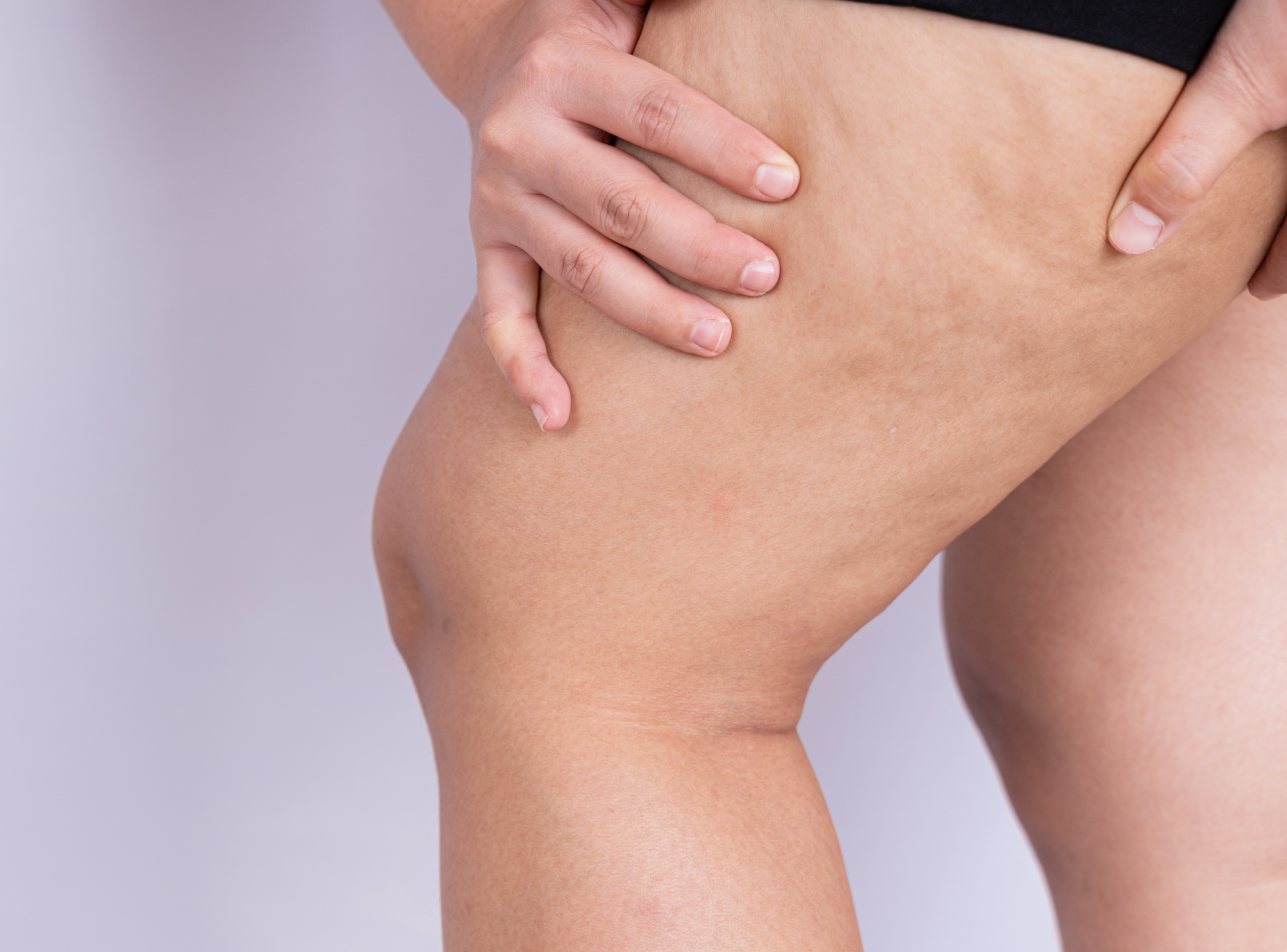 Potential Side Effects Associated with Cellulite Removal