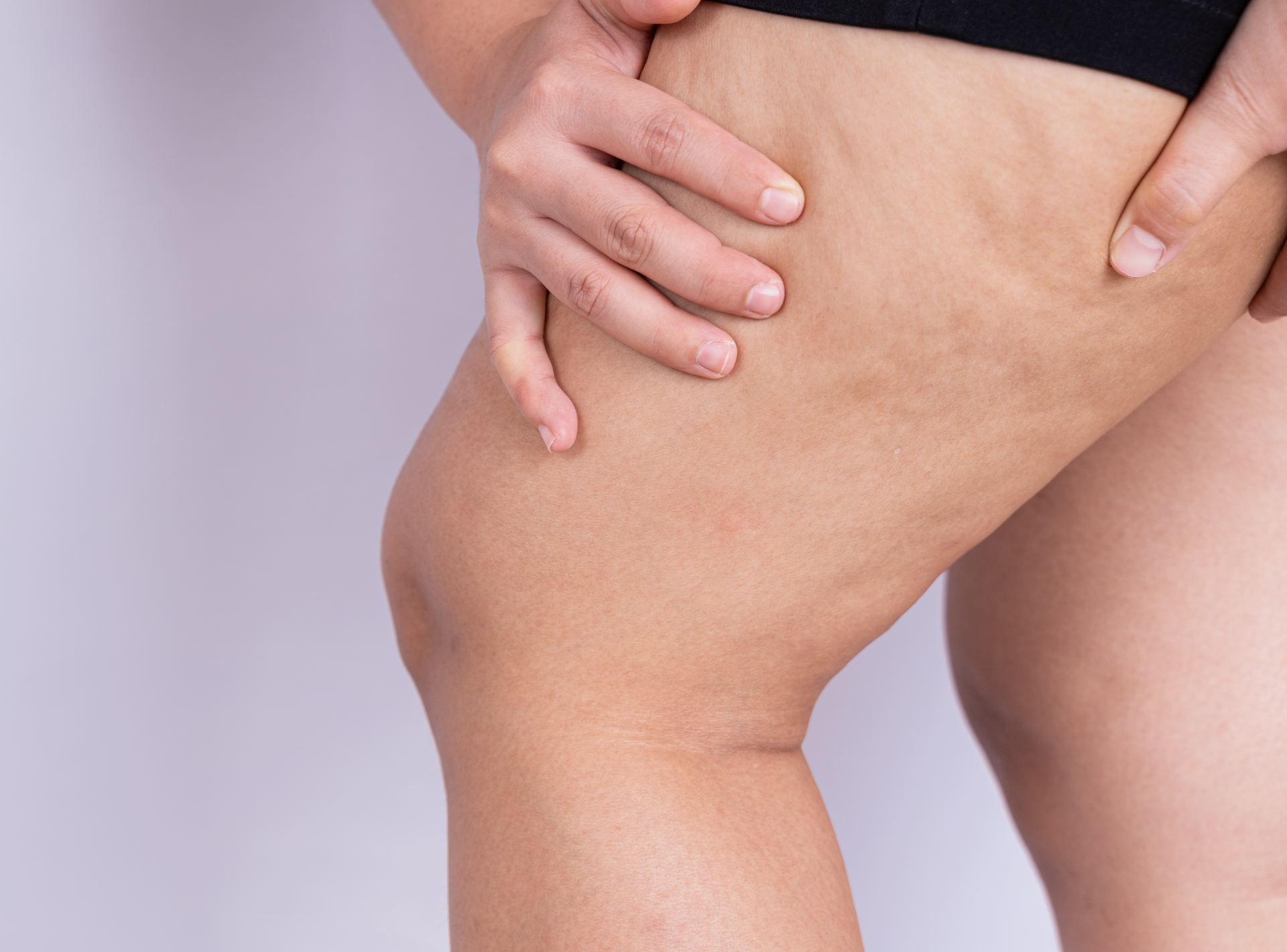 Can Cellulite Disappear on Its Own?