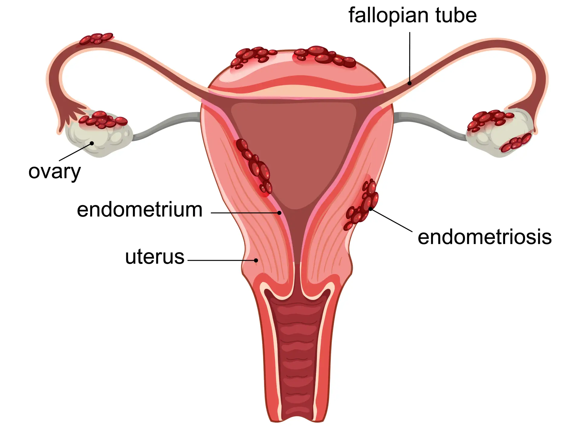 Is Endometriosis Dangerous? Know The Risks