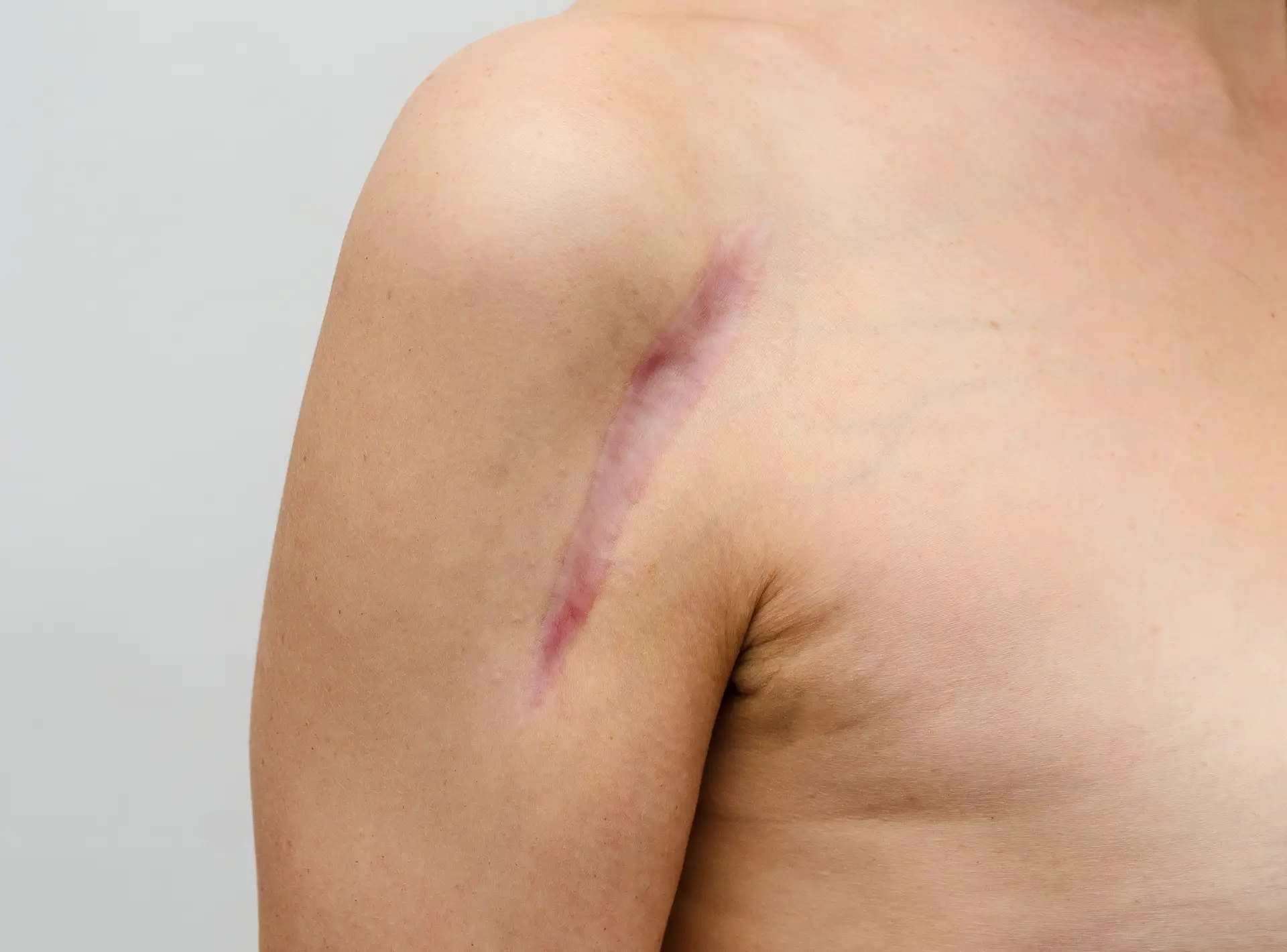 I Ask My Plastic Surgeon About Scar Revision